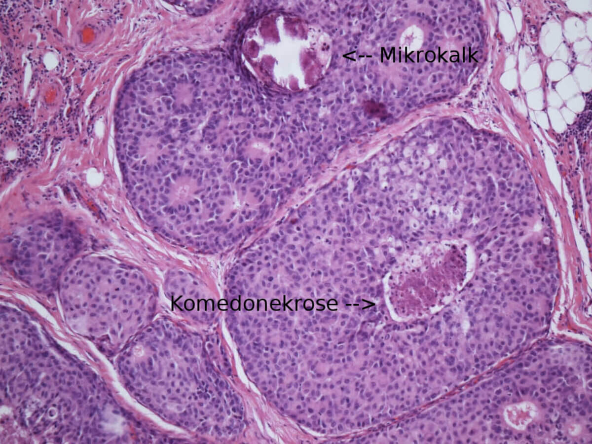 Duktales Carcinoma in situ