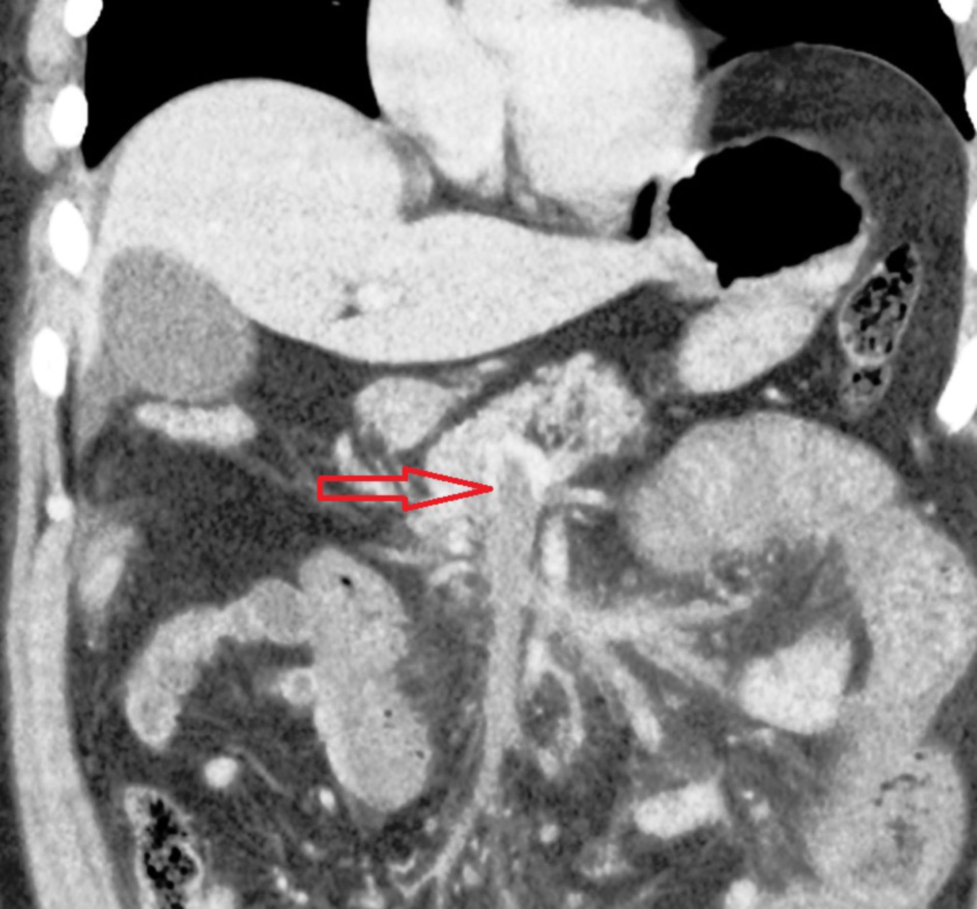 CT des Abdomens in frontaler Ebene mit Mesenterialvenenthrombose