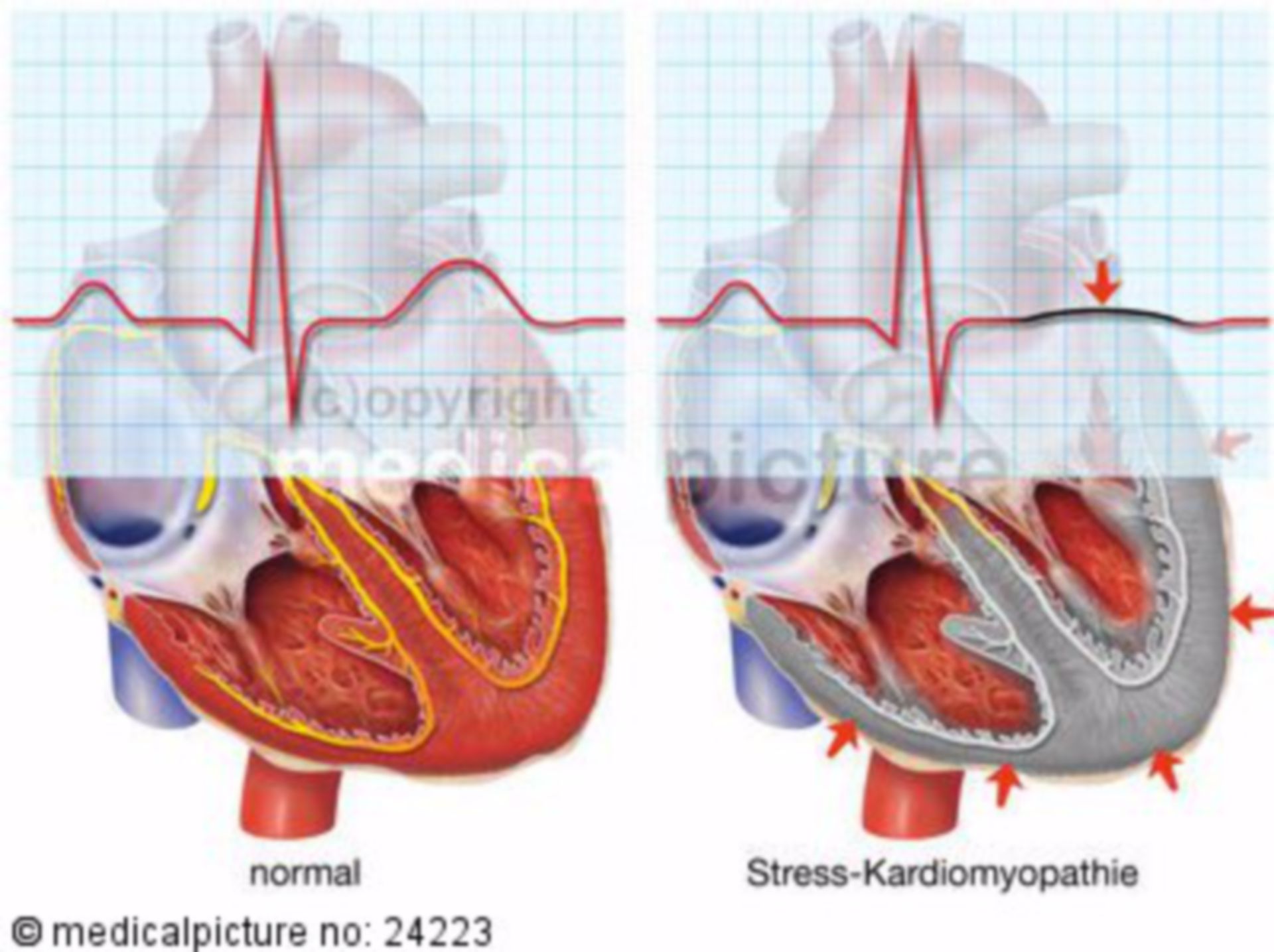 Stress-Kardiomyopathie