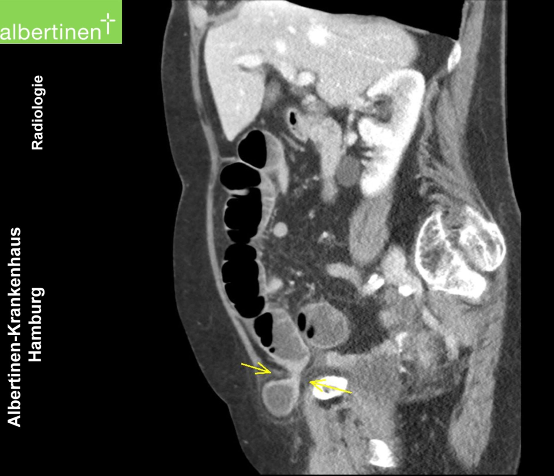 CT Ileus of a Hernia Sagittal Section