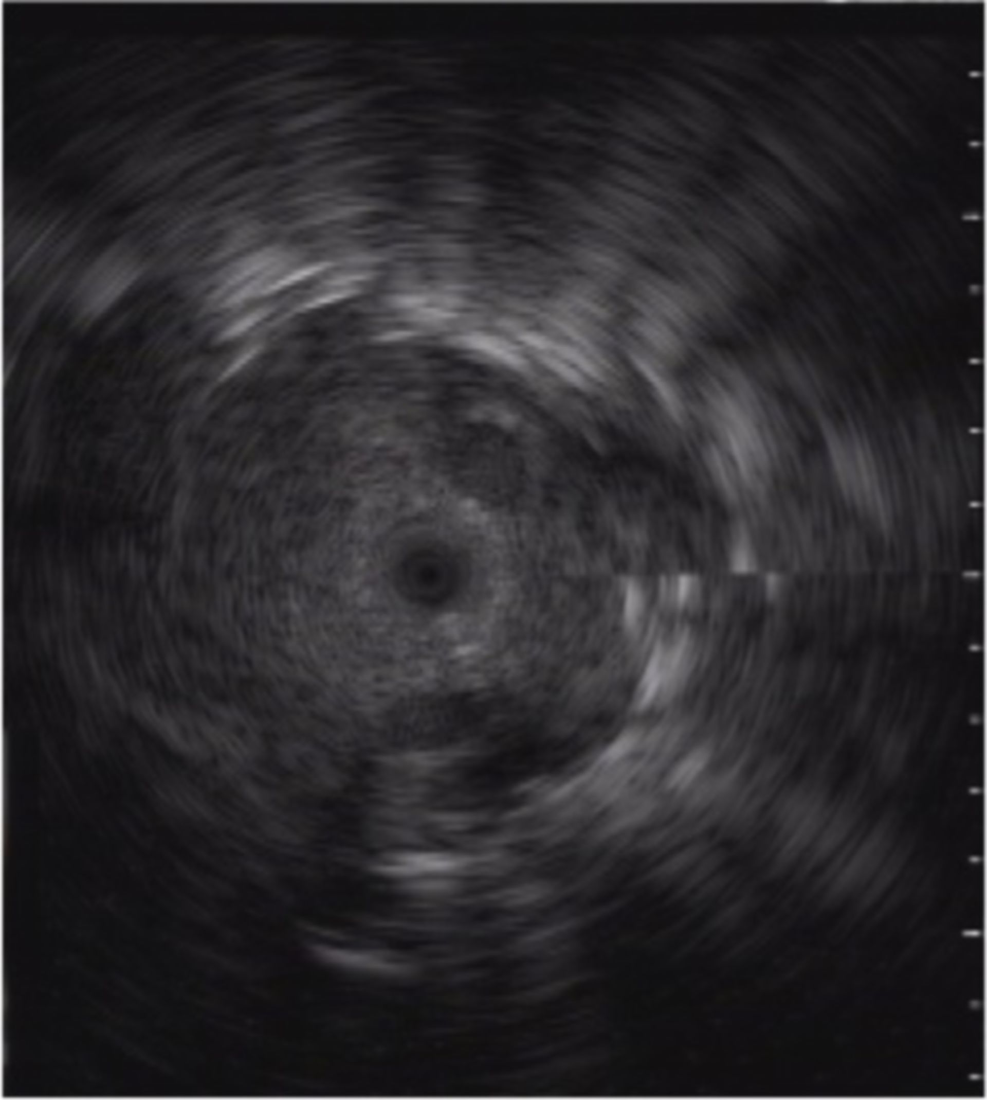Endobronchialer Ultraschall (EBUS)