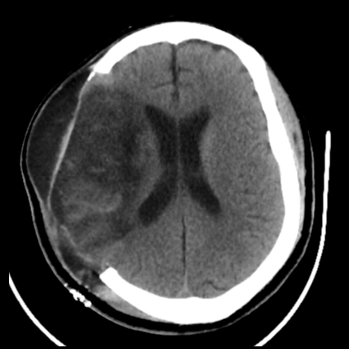 Dekompressive Hemikraniektomie