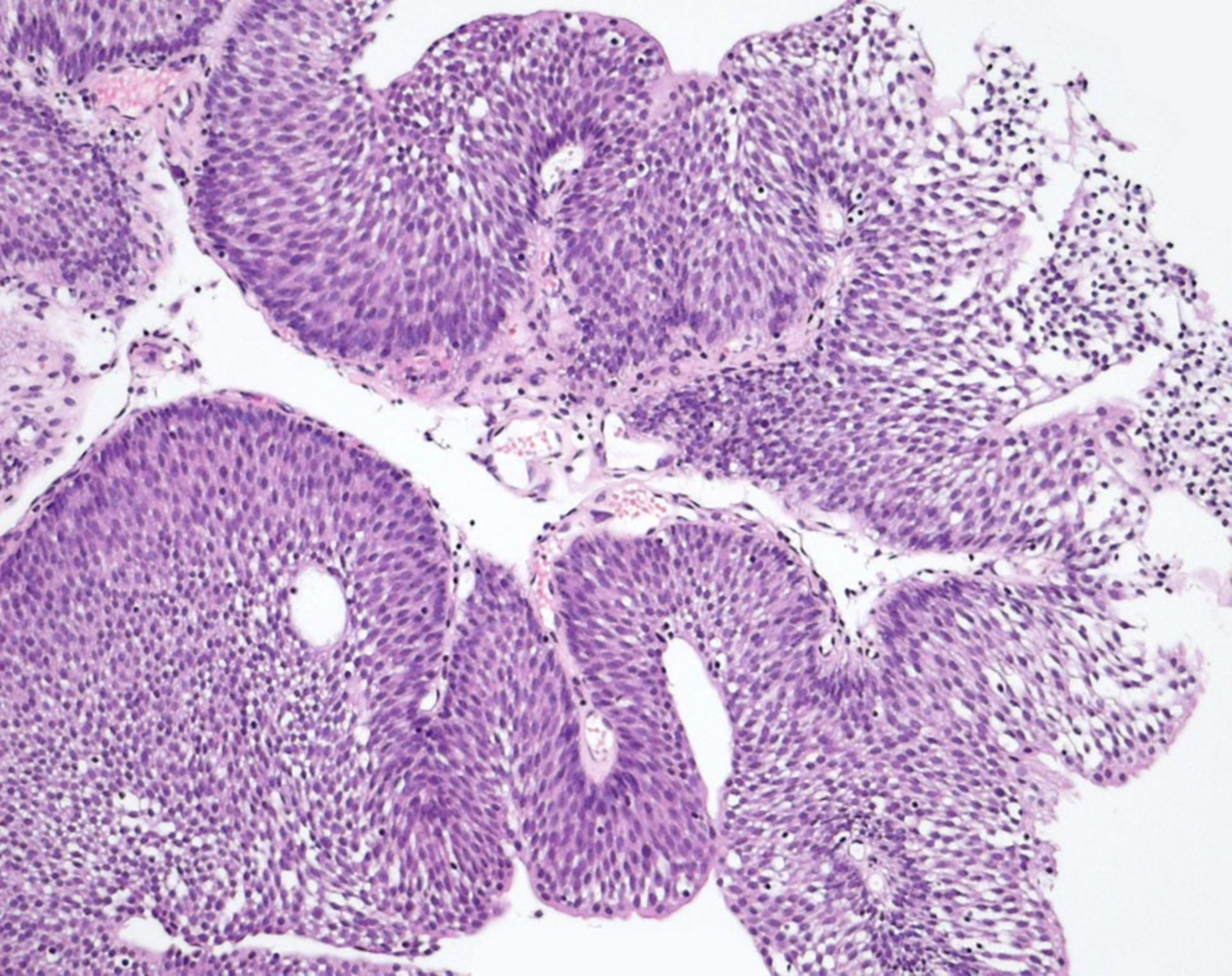 Papillary urothelial neoplasm low malignant potential. Papillary urothelial neoplasm tumors