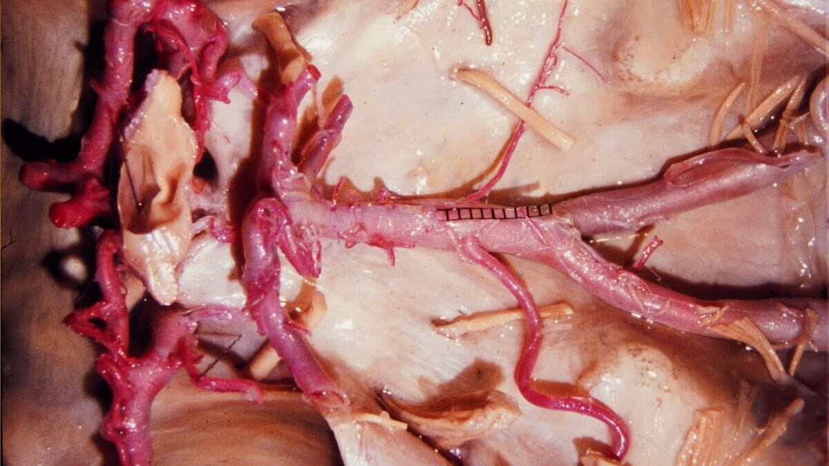 Circulus arteriosus cerebri