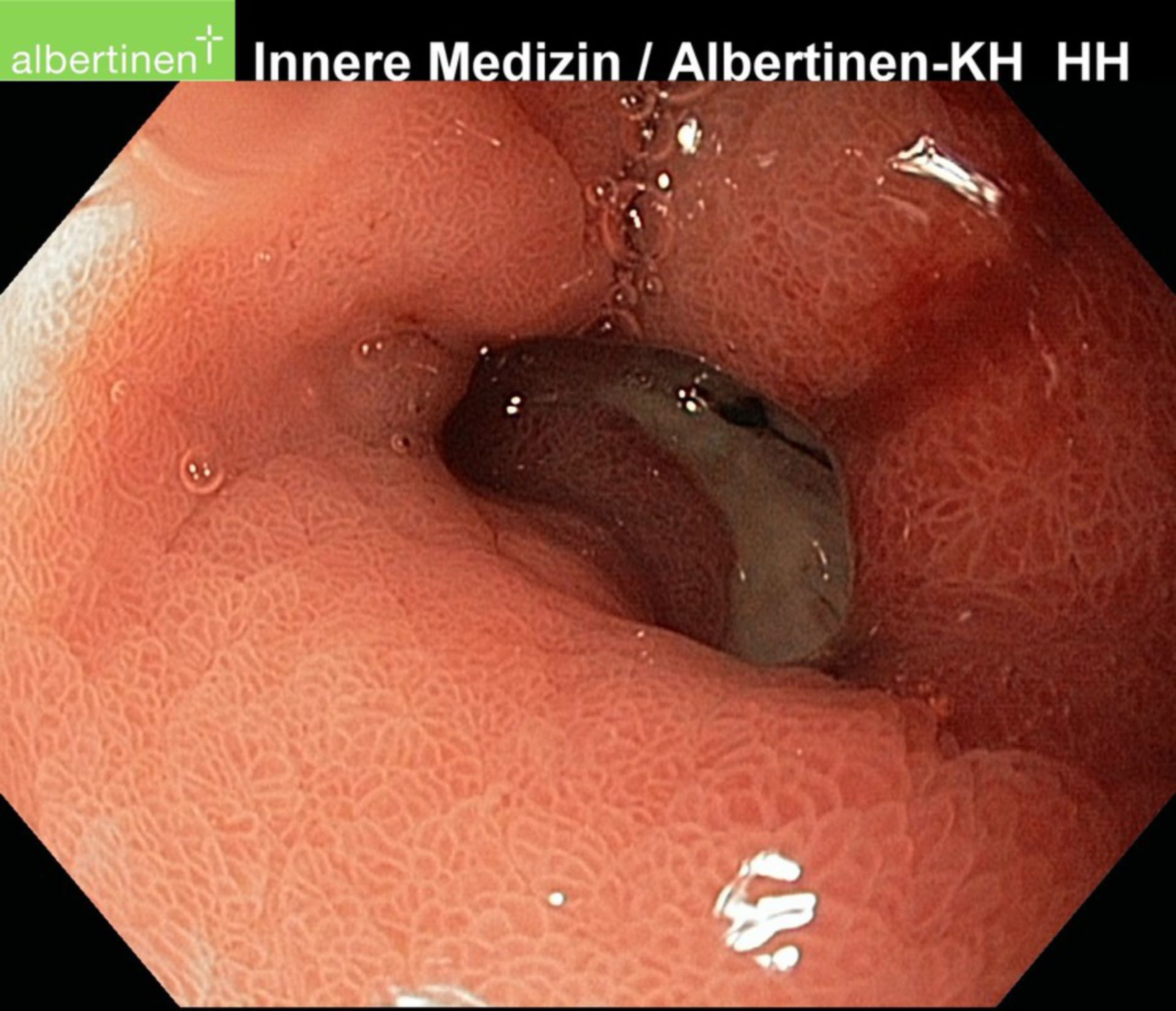 Acute duodenal ulcer