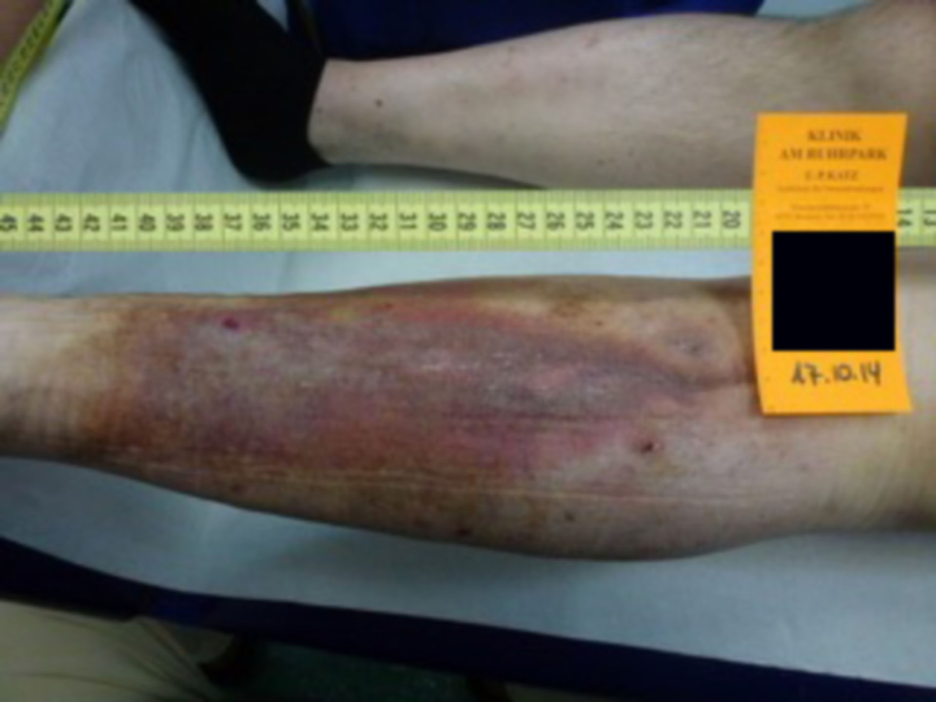 Ulcer of the lower leg - open for 20 years: day of discharge (17)