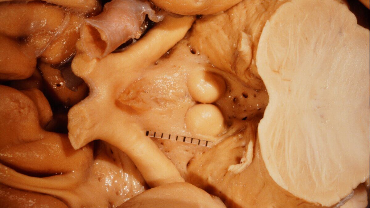 Diencephalon