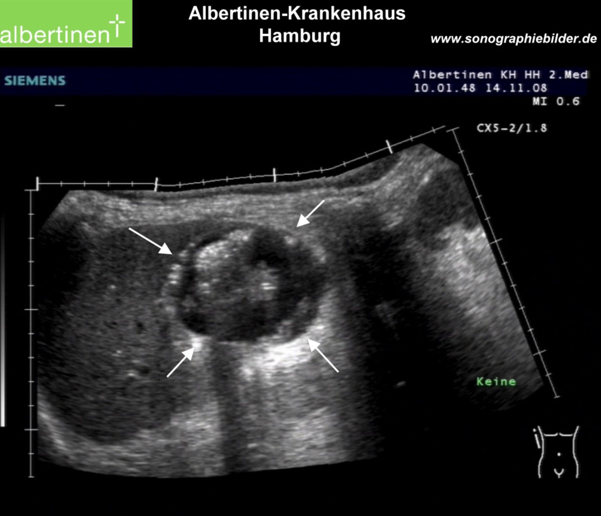 Sonography: Abscess in the Liver