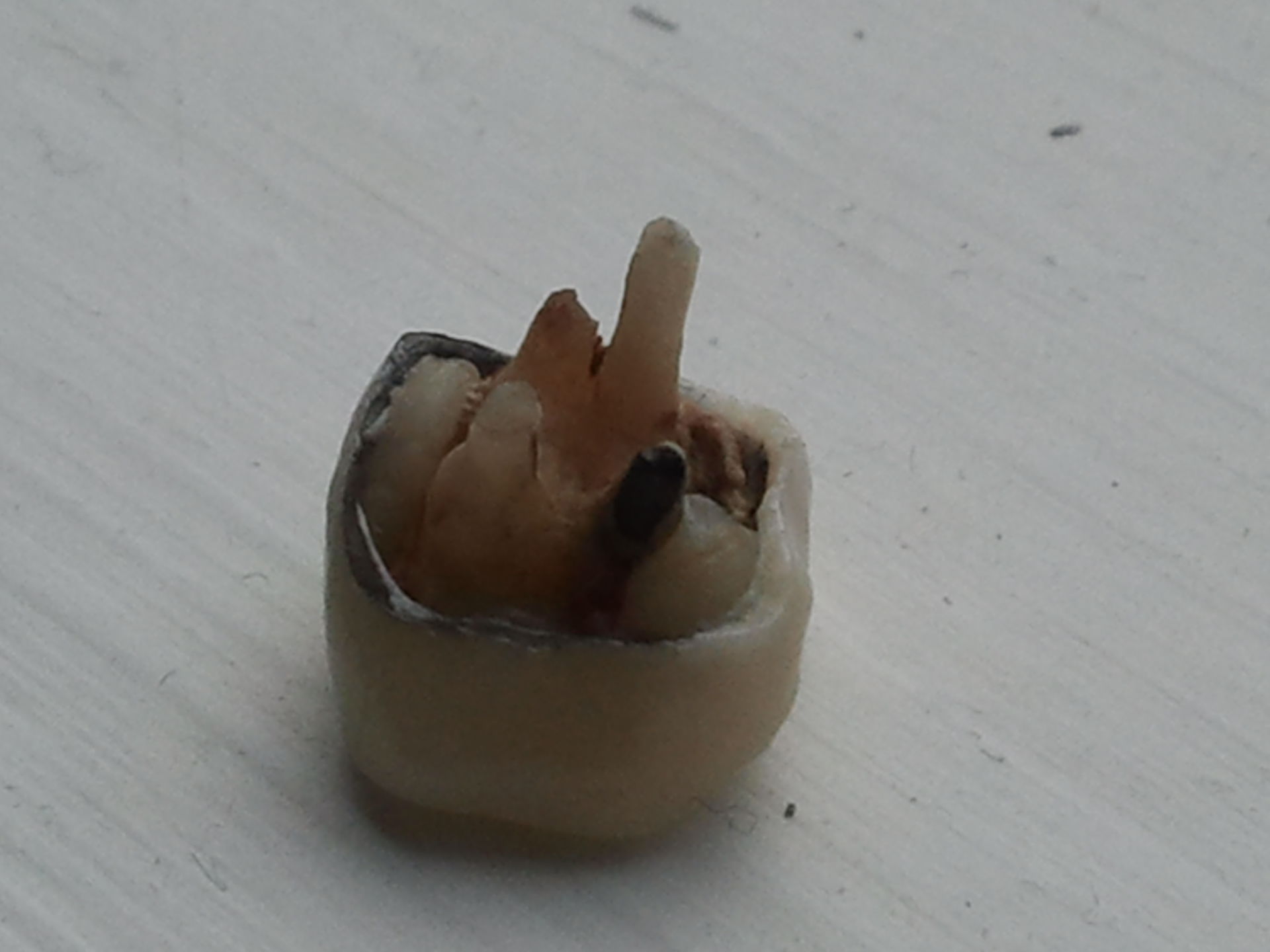 Zahnkrone herausgefallen von Seite
