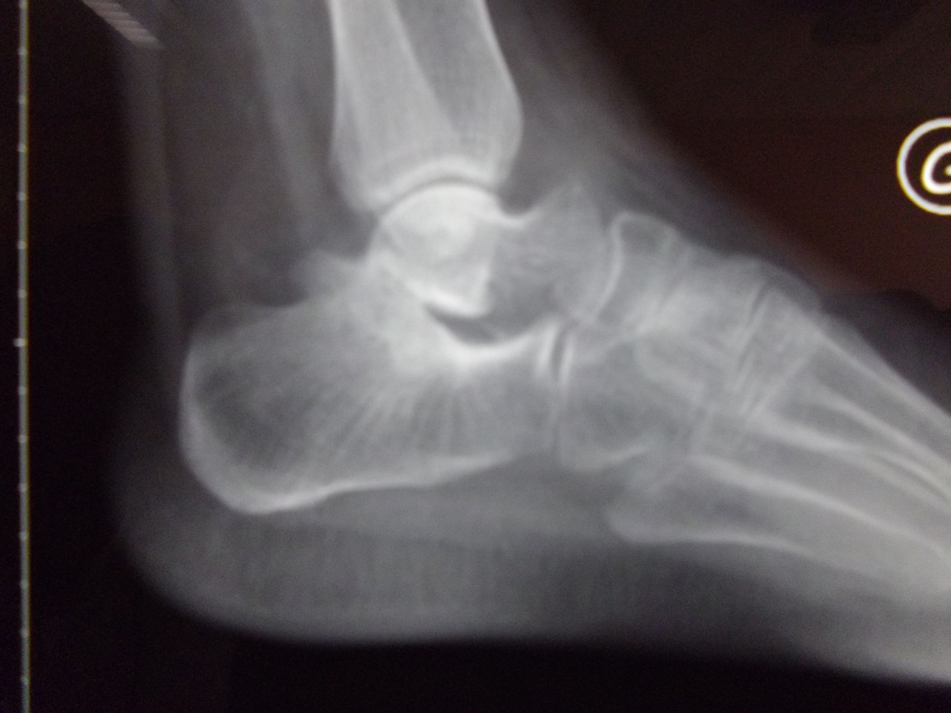 Osteoartrite del piede