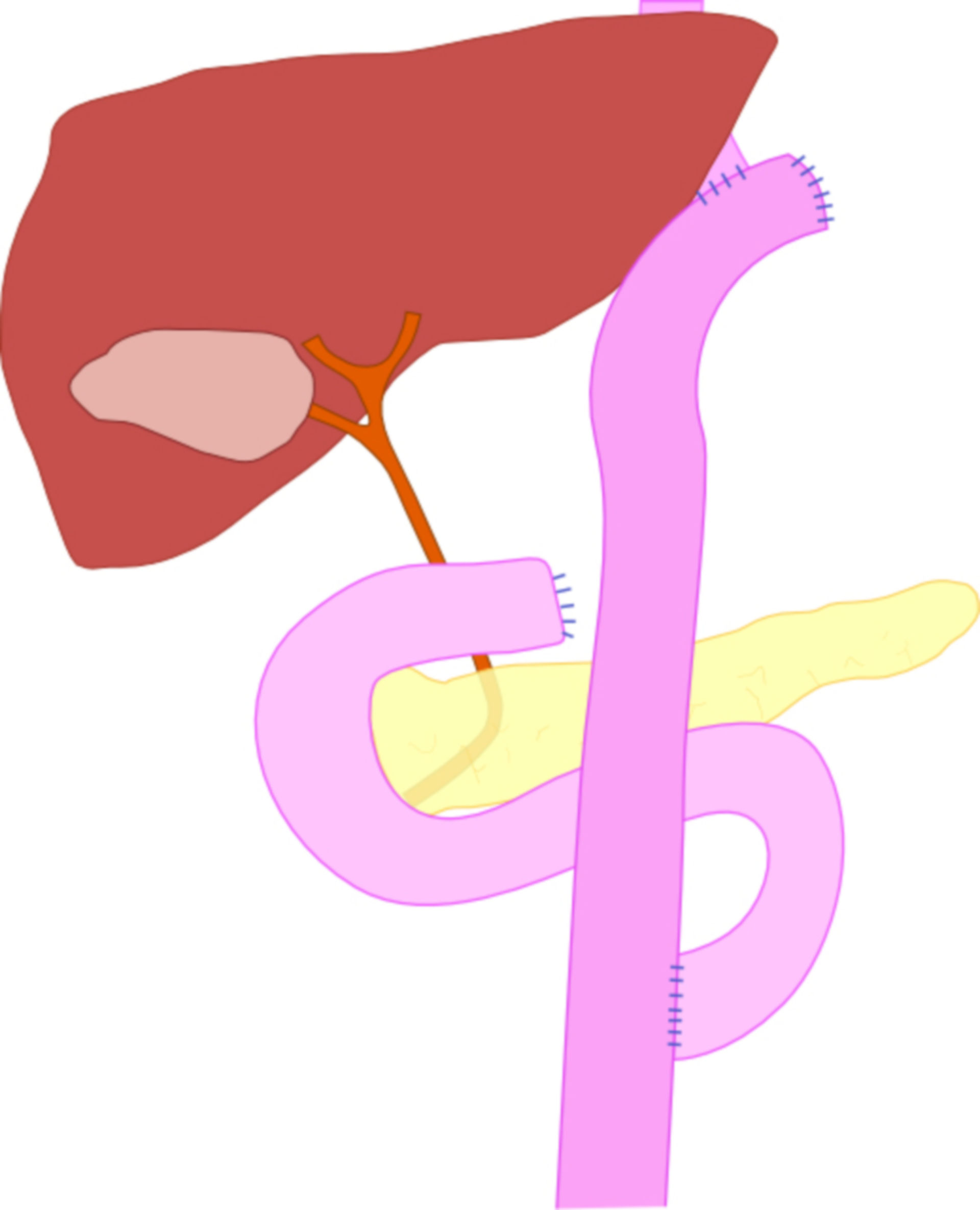 Gastric resection, Roux en-Y