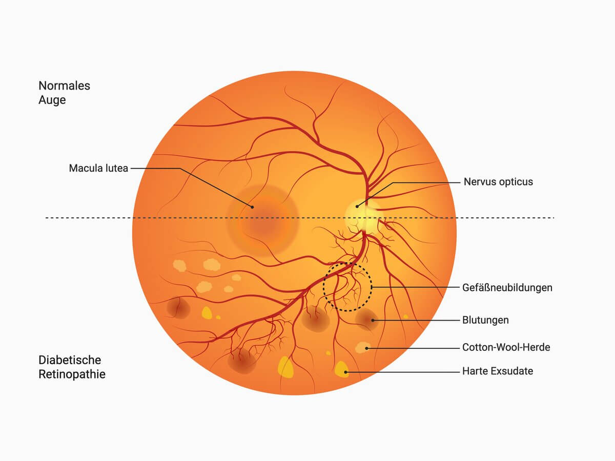 Diabetische Retinopathie