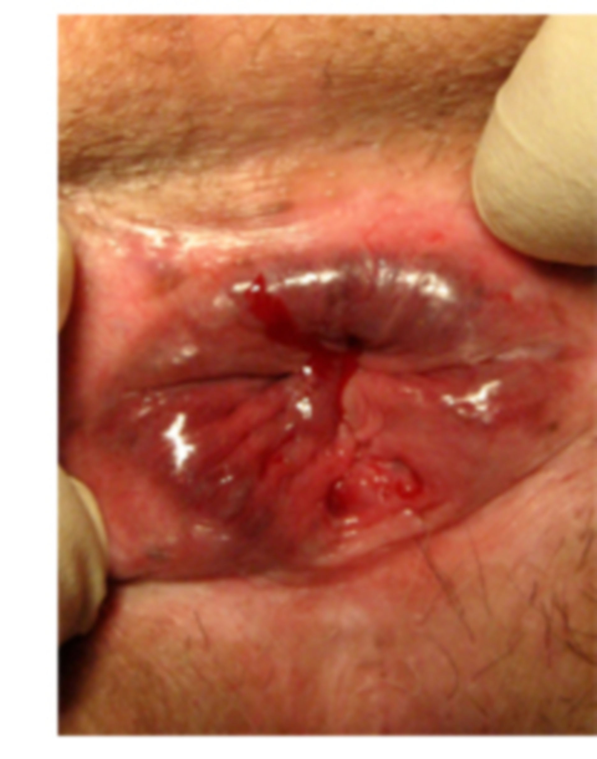 Anal fissure: acute fissure