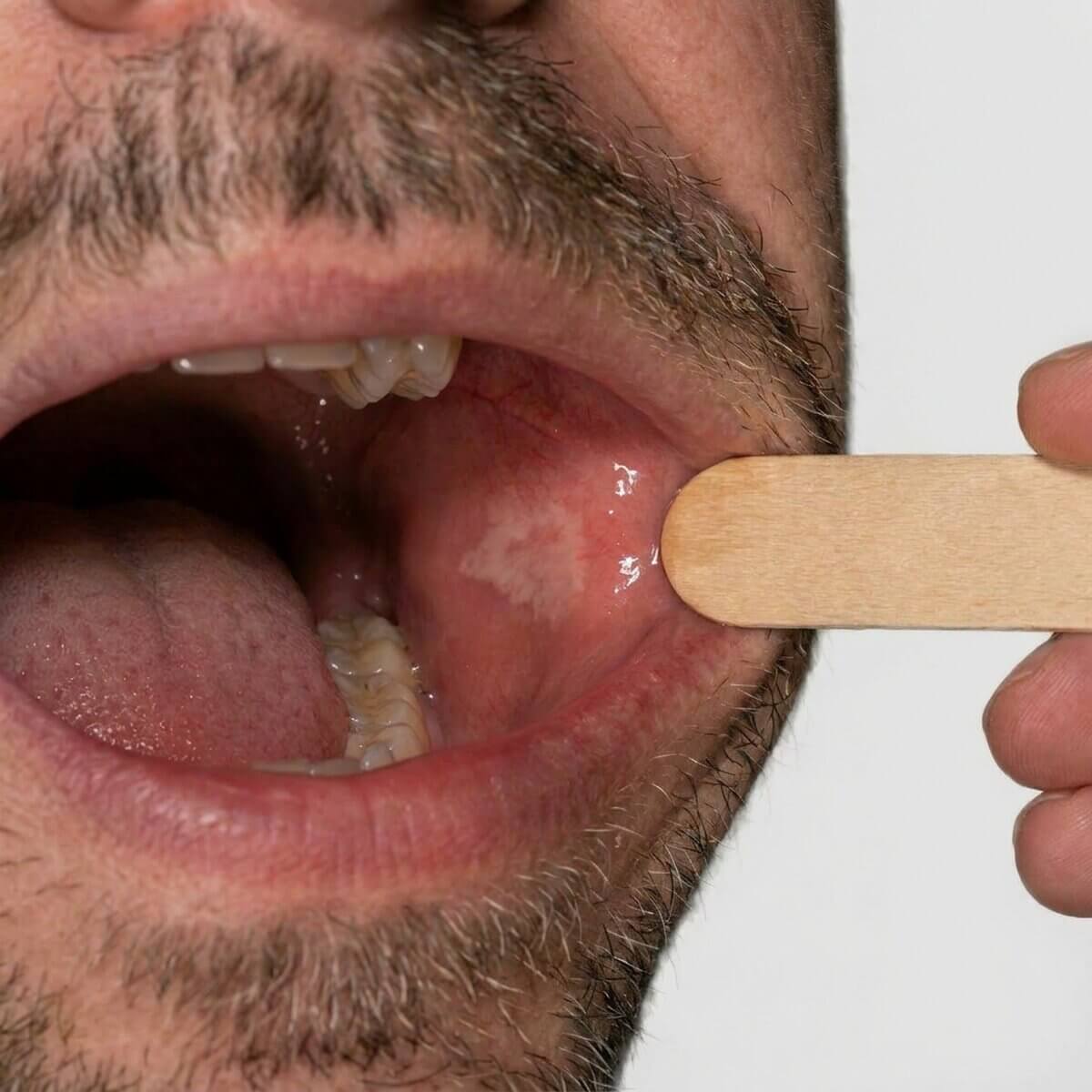 Leukoplakie