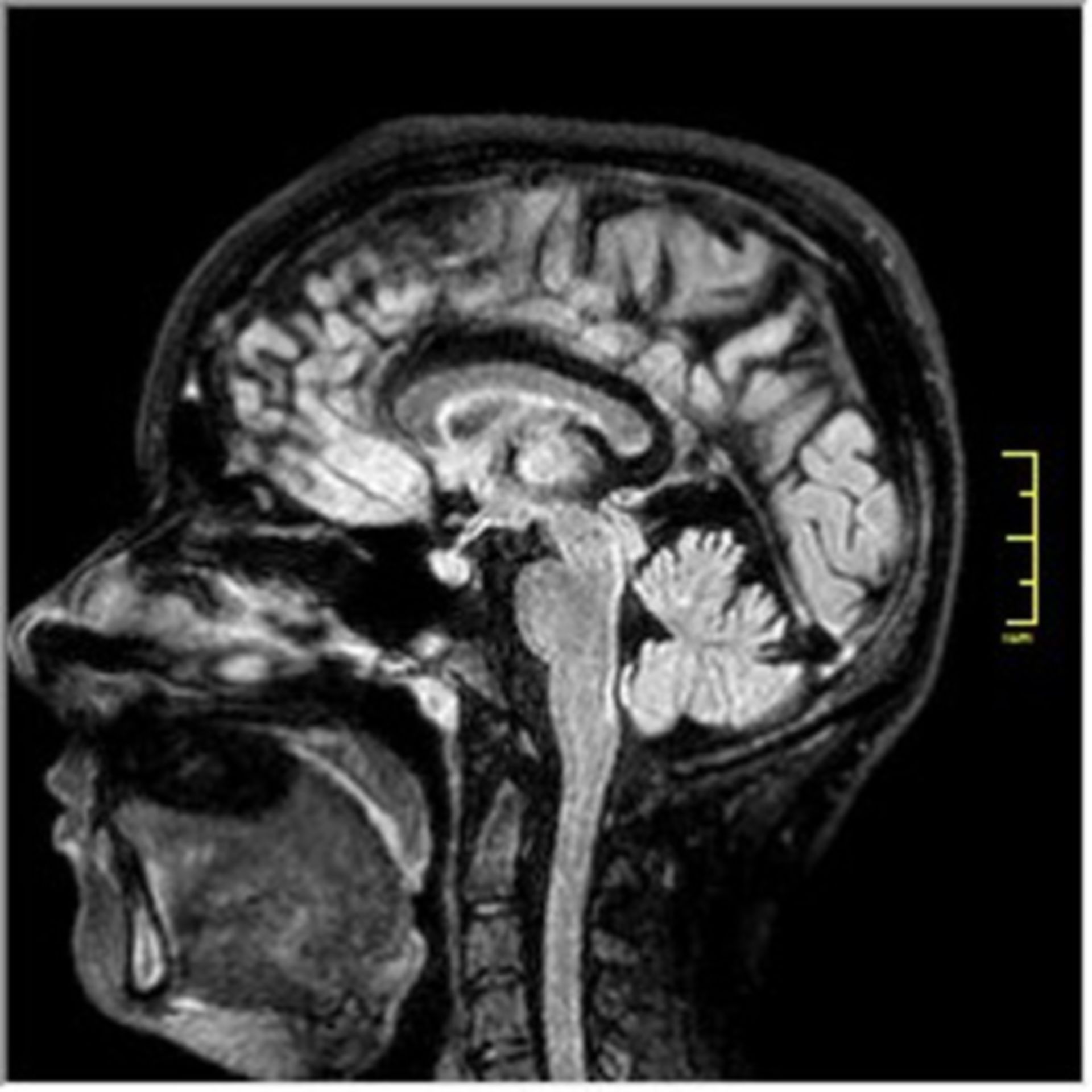 (8) MRI flair 3d fs2 S2 I150