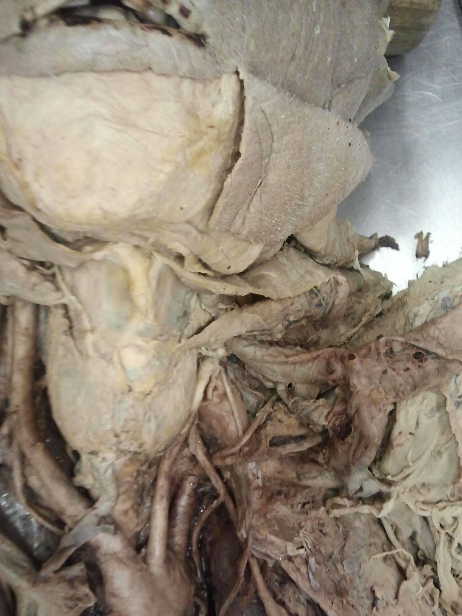 Tronco arteriosa brachiocefalico (2)