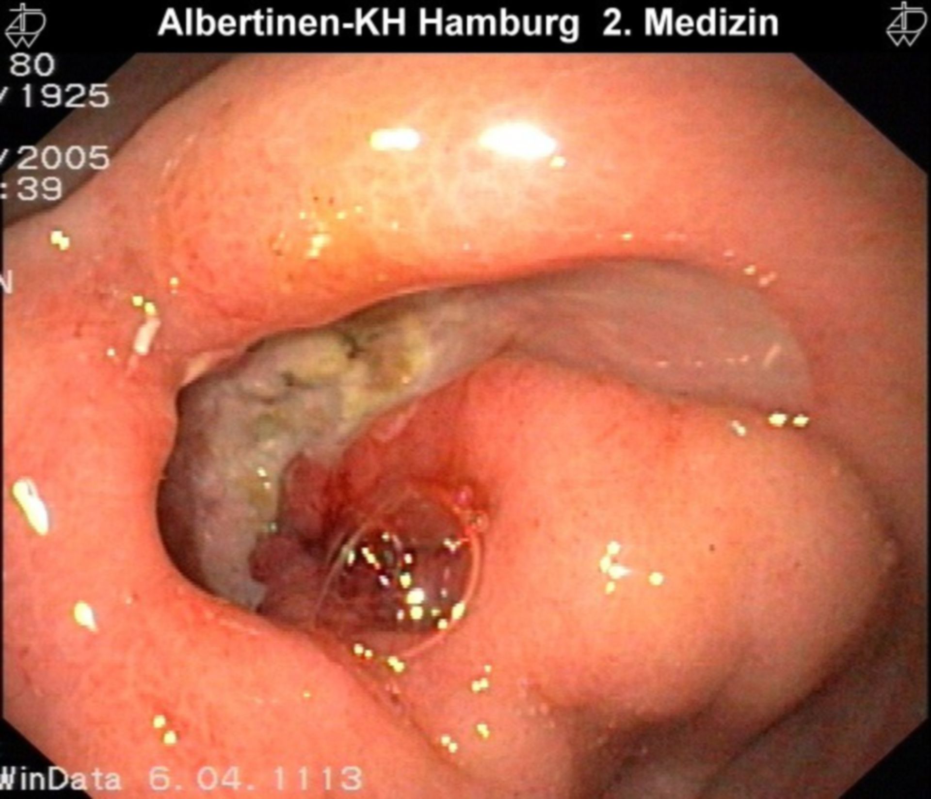 Ulcera antrale