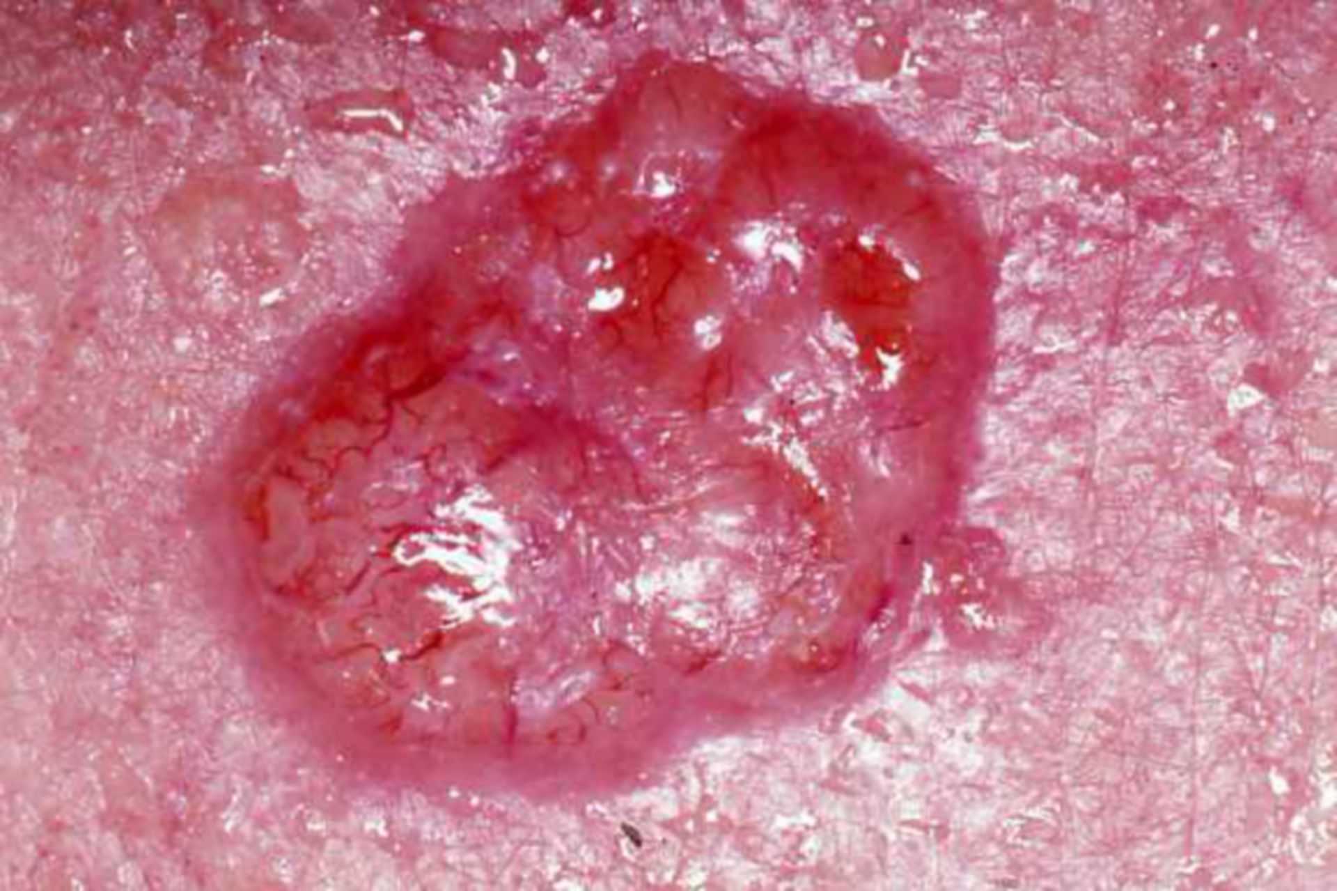 Carcinoma basocelular