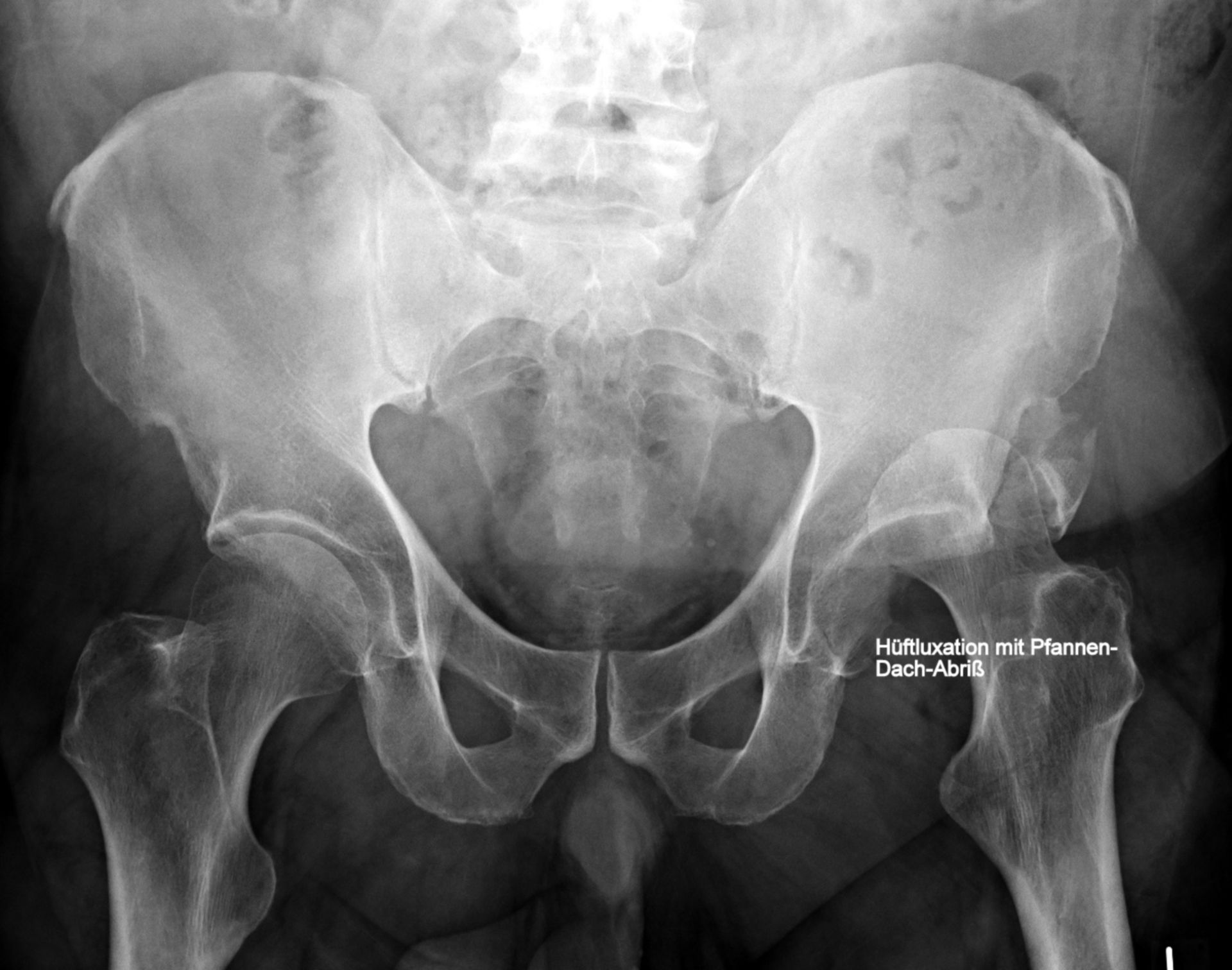 Dislocation of hip joint