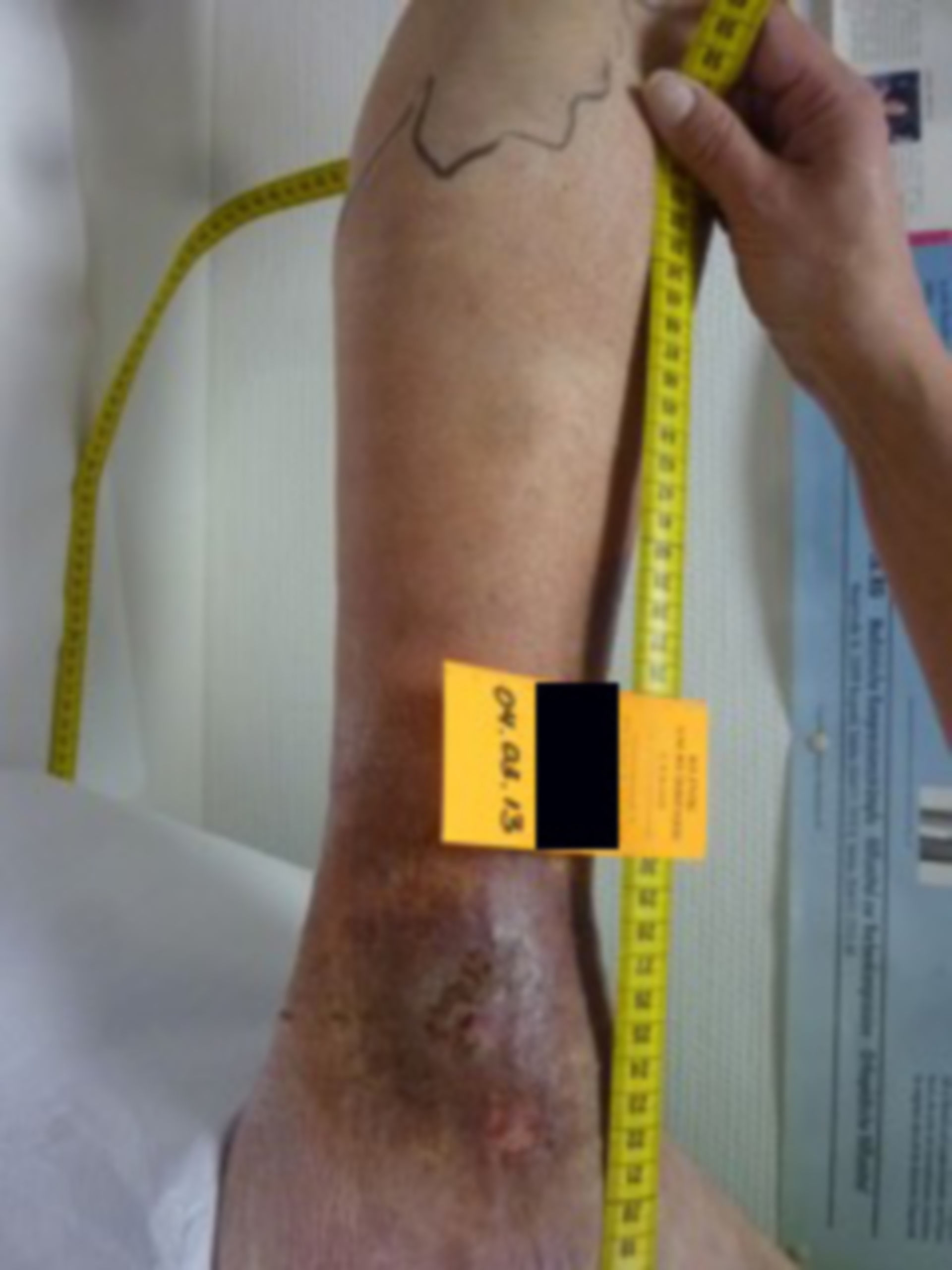 Erysipelas and ulcers (two years open)
