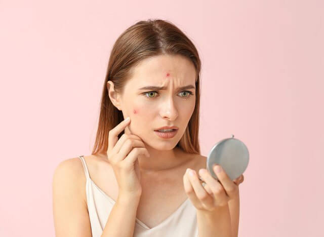 woman-with-acne_original.jpg