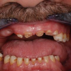 Abrasion DocCheck Flexikon