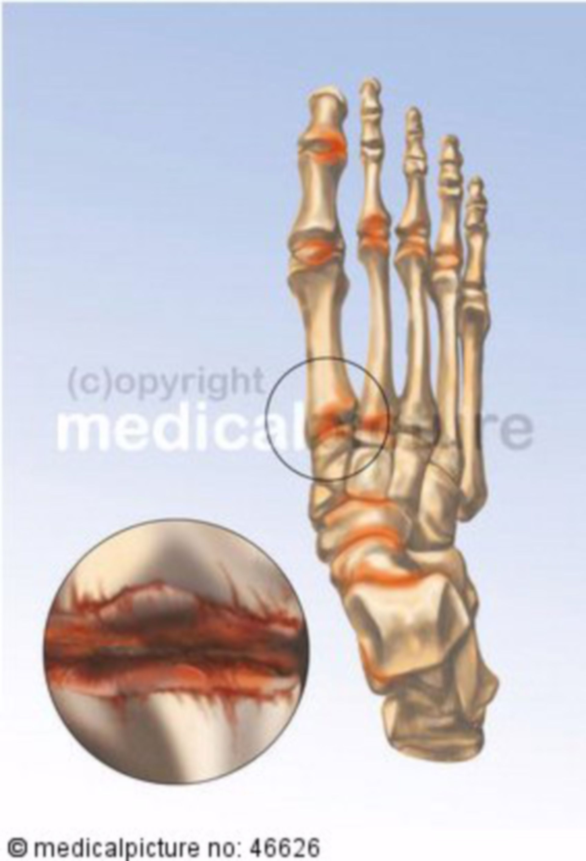  Menschliches Fußskelett mit Arthritis 
