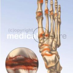cauzele edemului măduvei osoase a articulației genunchiului durere în tratamentul articulațiilor șoldului