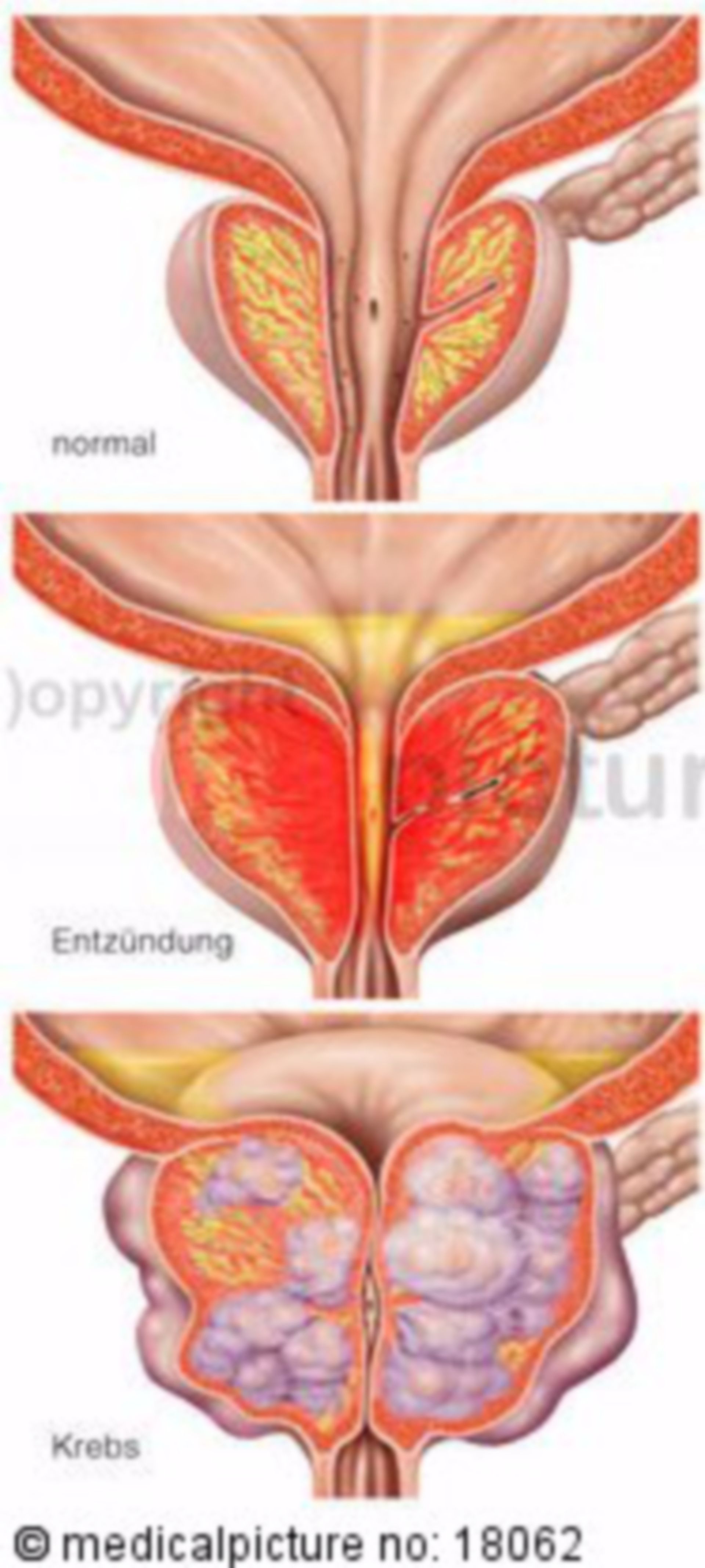 Veränderungen des Drüsengewebes der Prostata
