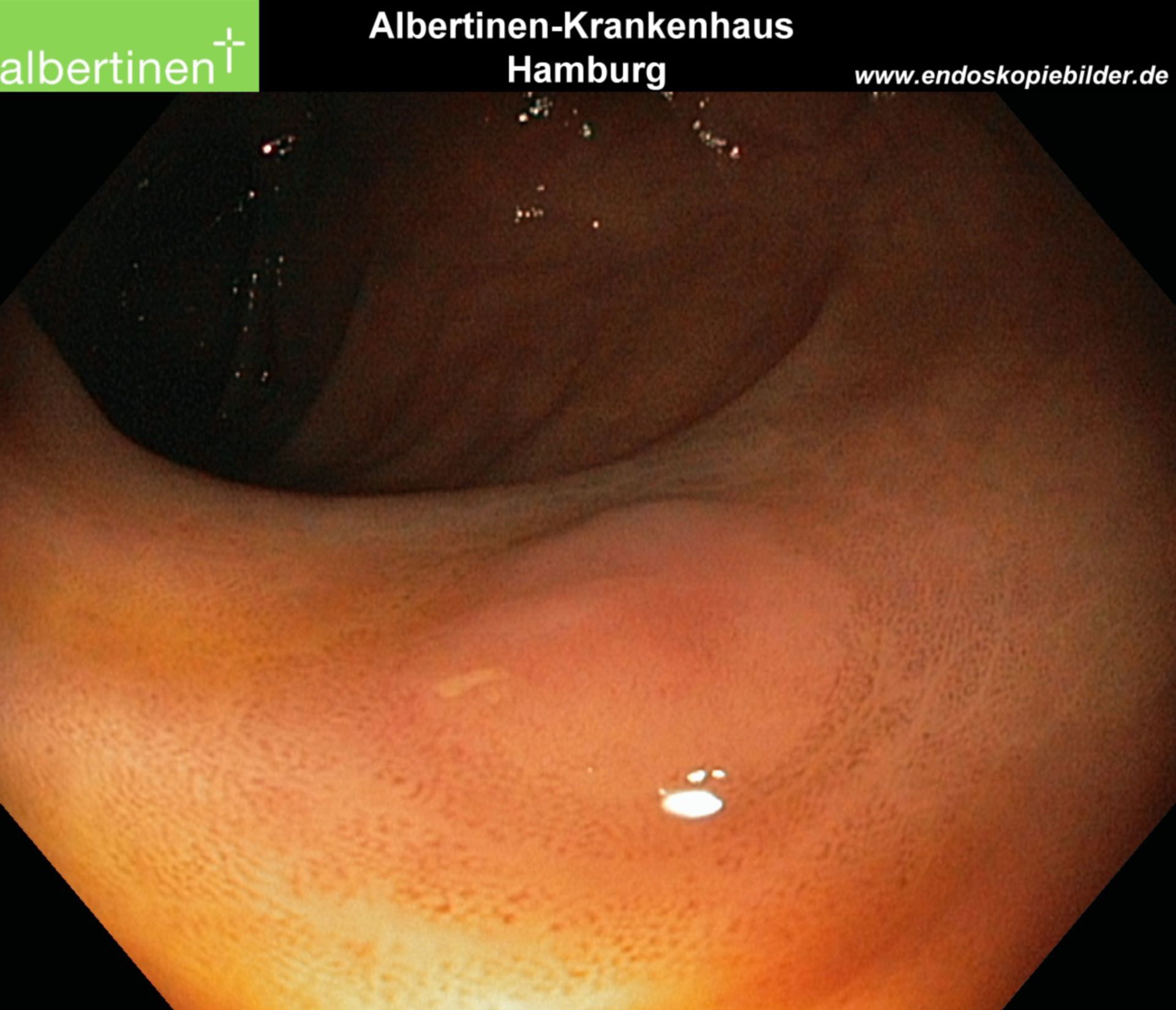 Endoscopy: Polyp Bud