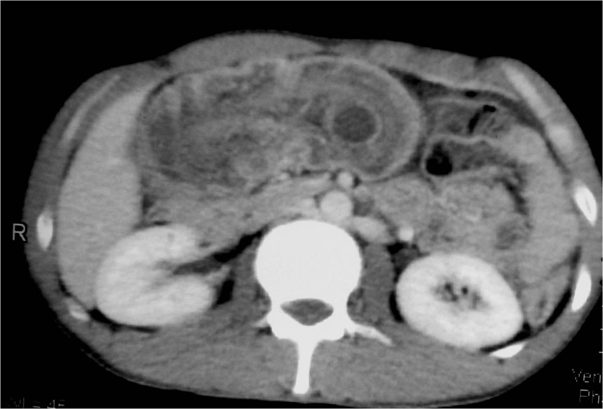 Mukozele der Appendix vermiformis (3)