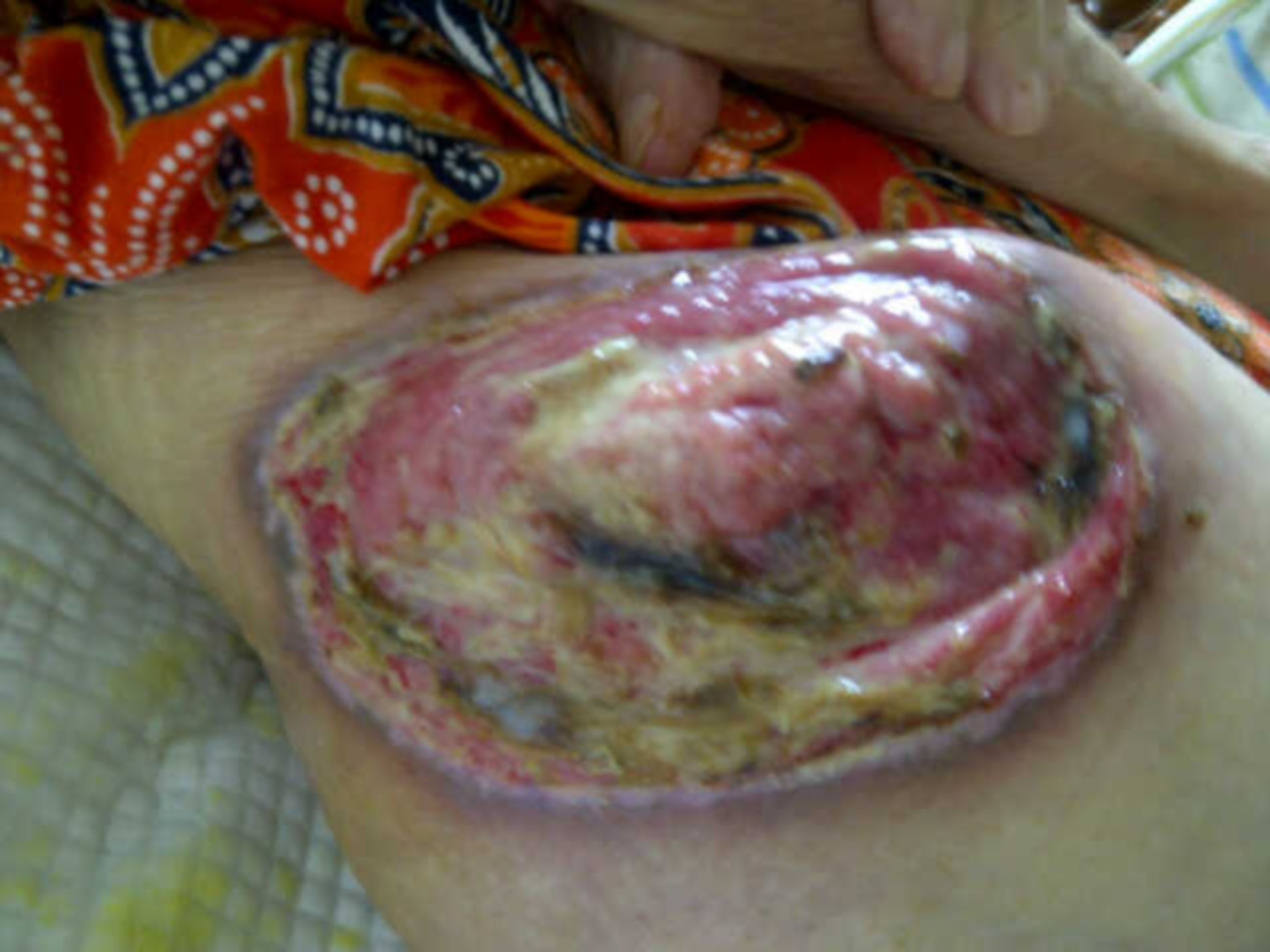 Ulcero da decubito