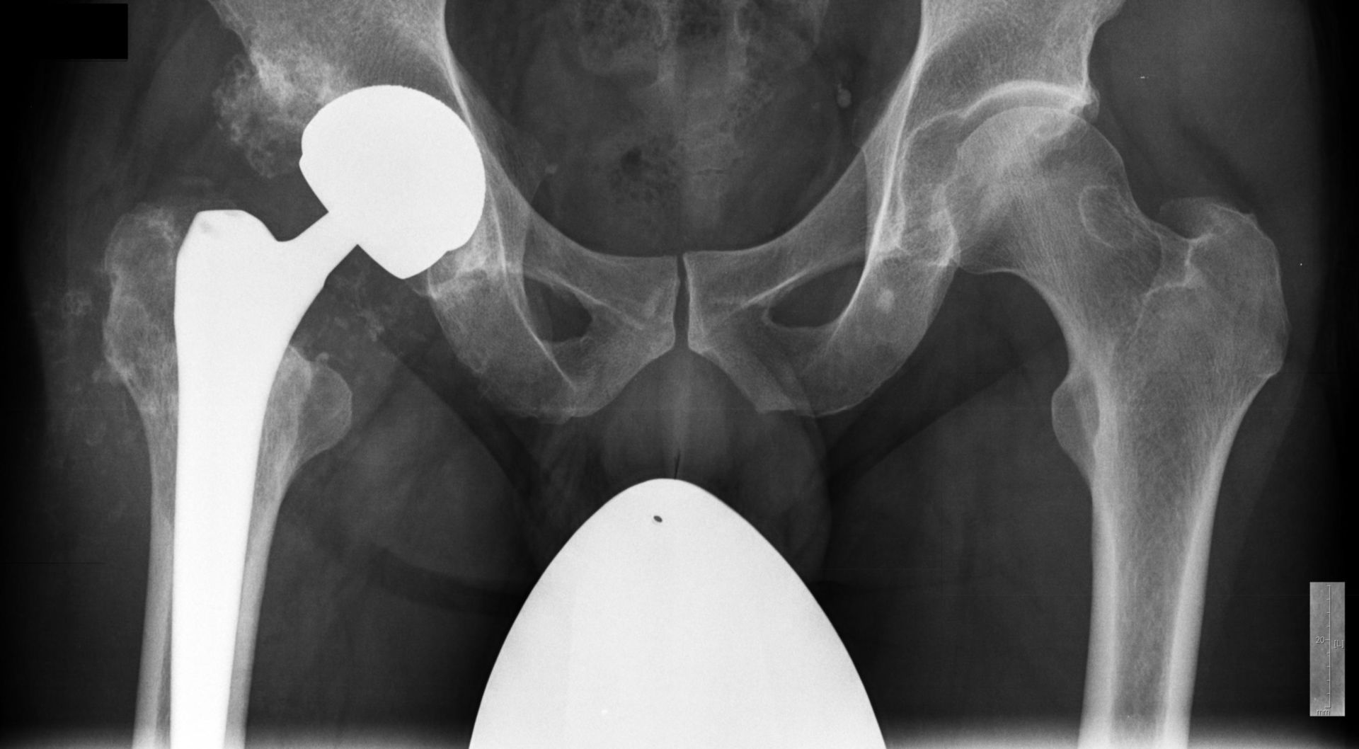 Chondrosarcoma in condition after right hip replacement, 2 plain x-ray Aug 2010