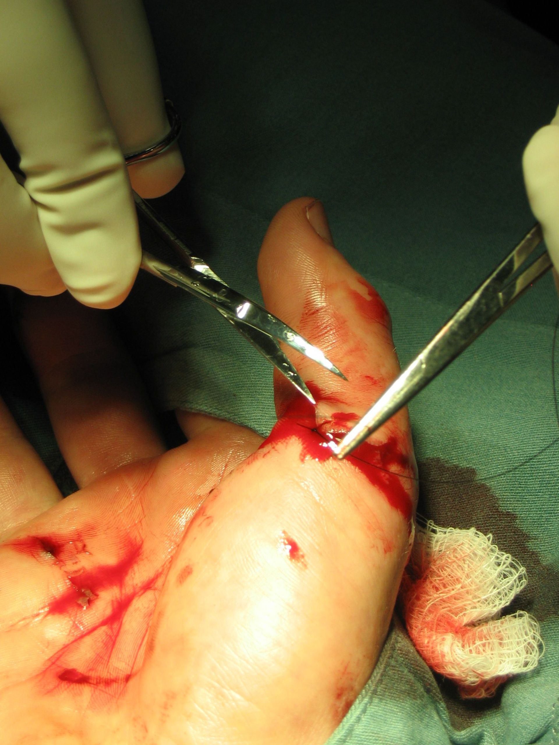 Chirurgia della mano