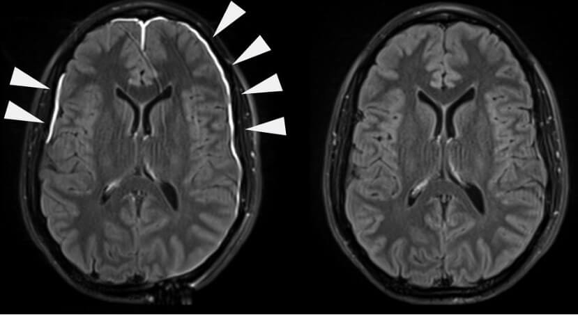 doccheck_-_08_-_infektiologische_notfa_lle_bild3_meningitis_original.jpg