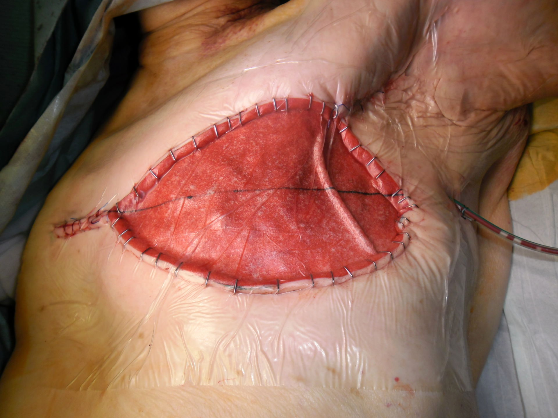 Mammary carcinoma recurrence - artificial skin transplant