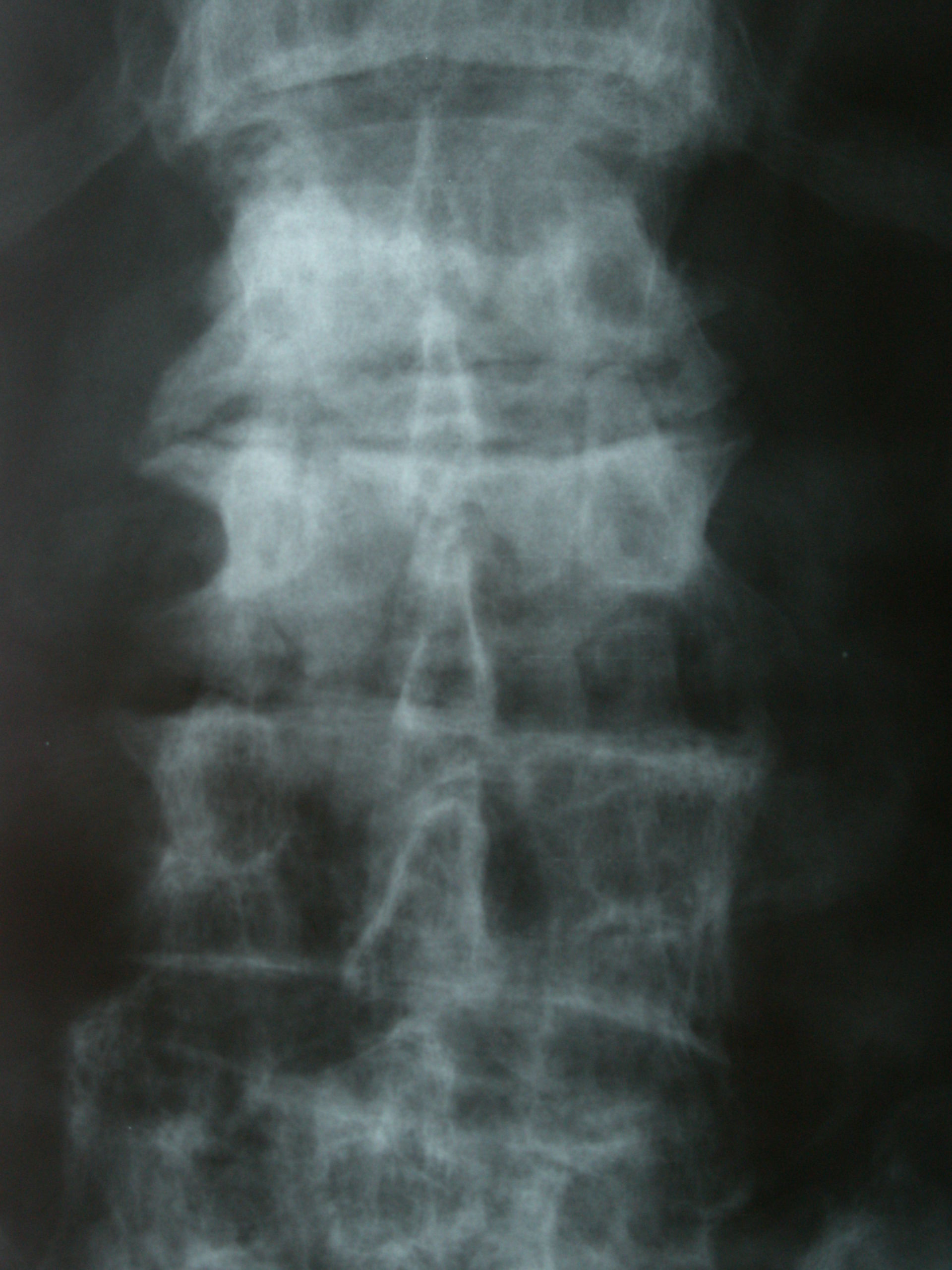 Il morbo di Paget dell'osso: colonna vertebrale