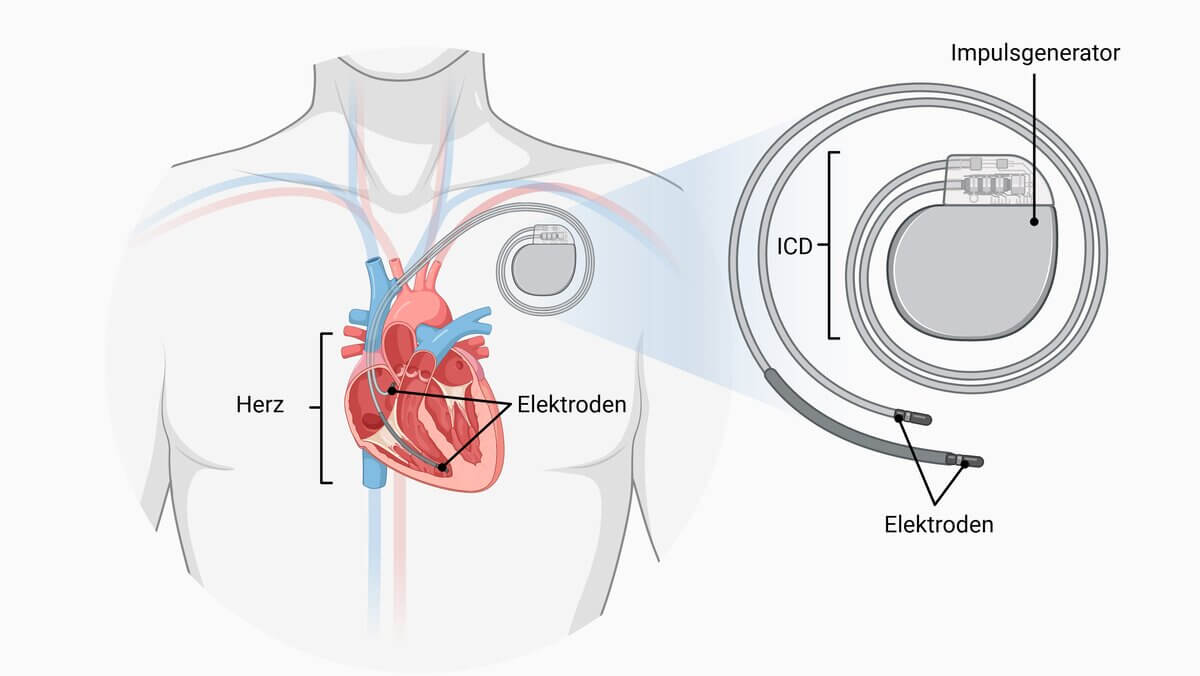 Implantierbarer Kardioverter-Defibrillator (ICD)