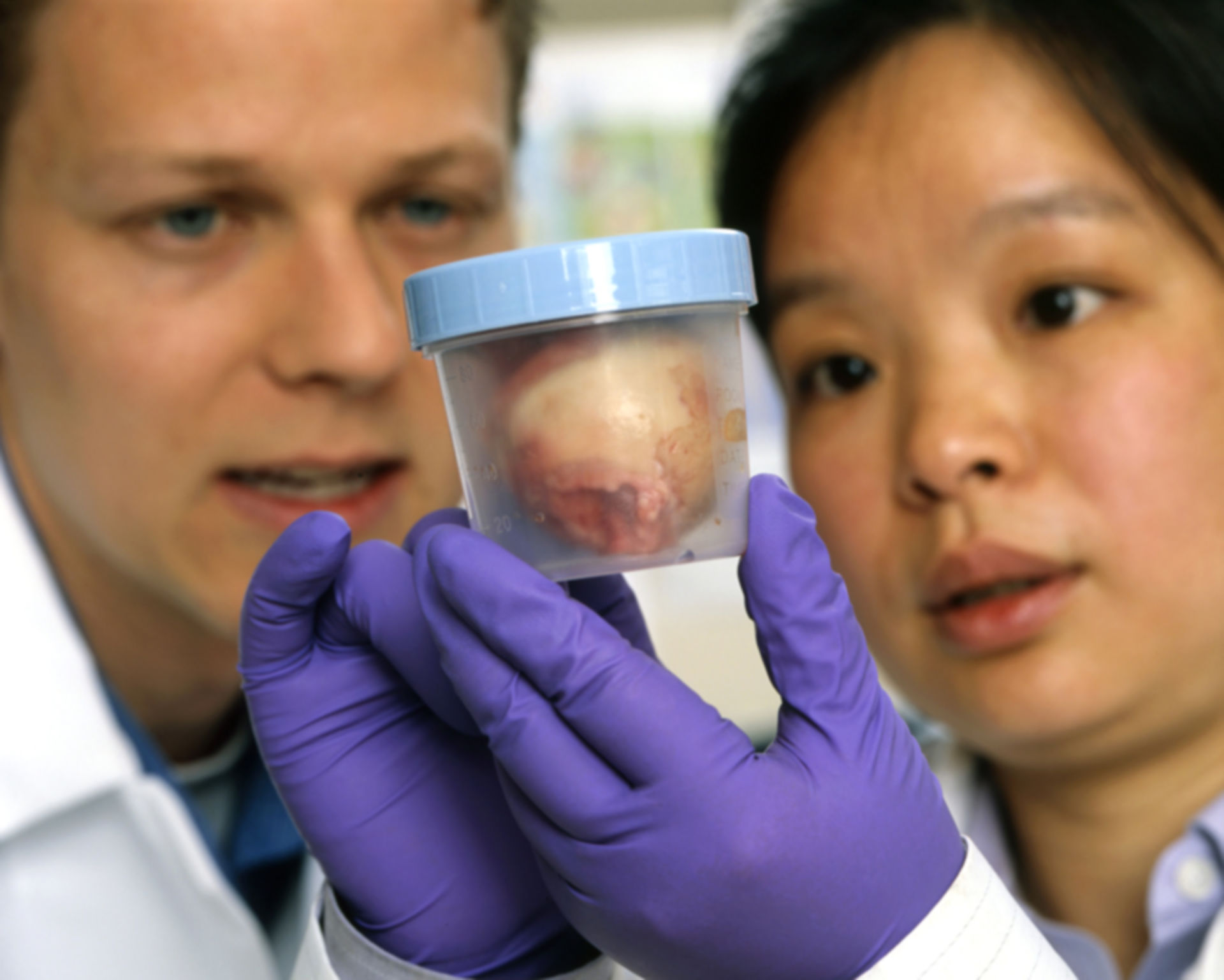 Human Femoral Head Used to Harvest Adult Stem Cells