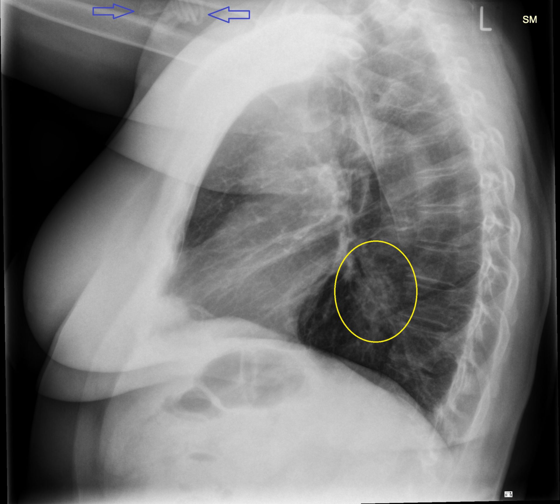 th_seitl1: Röntgen des Thorax von lateral