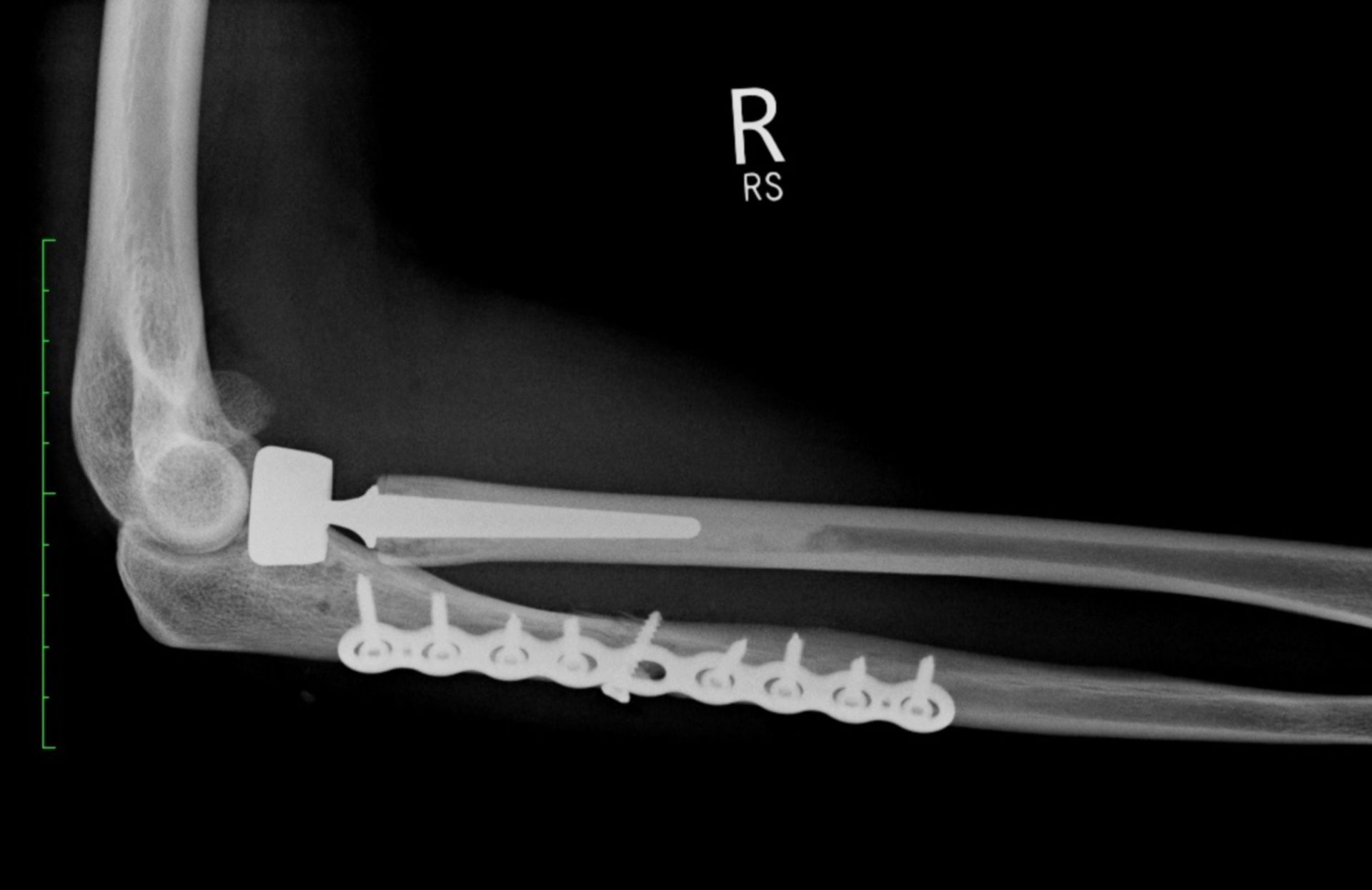 Röntgen des Ellenbogens rechts nach osteosynthestischer Versorgung der Ulna und Radiusköpfchenprothese