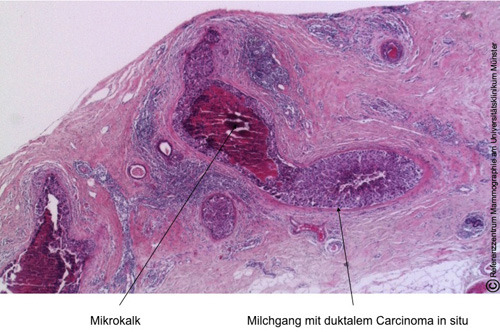 Nach Gewebeprobeentnahme zeigen sich in der feingeweblichen Aufarbeitung die mit Tumorzellen ausgefüllten Michdrüsengänge; dazwischen lassen sich Mikroverkalkungen (Pfeil) erkennen. © Referenzzentrum Mammographie