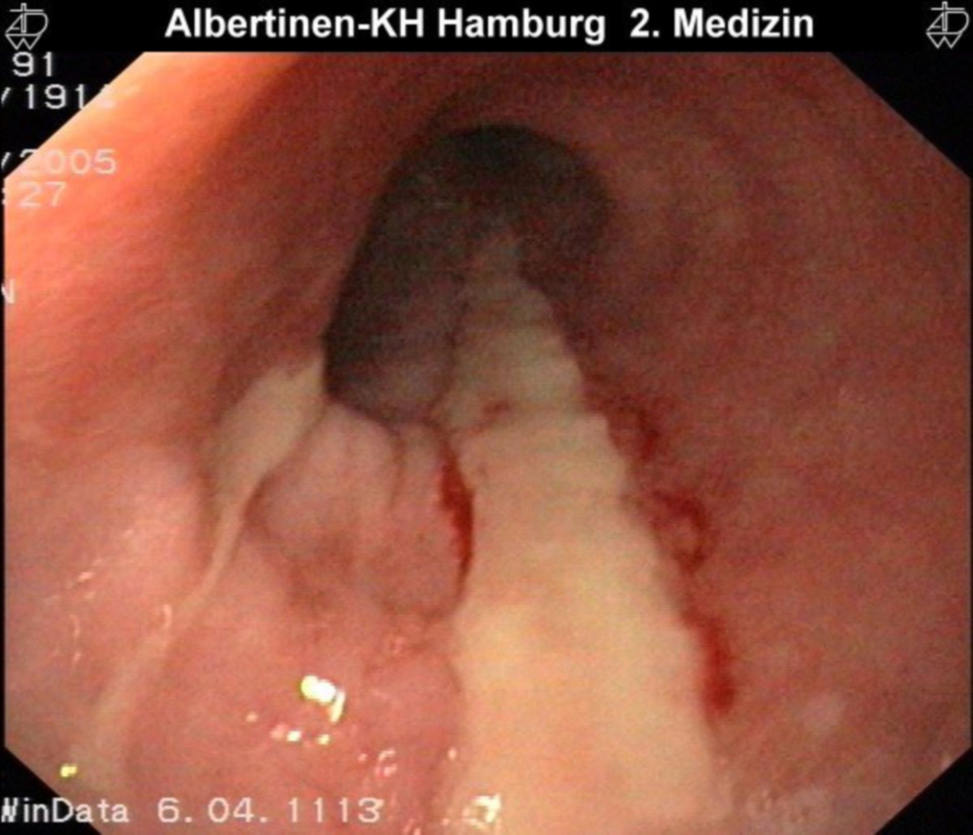 Fibrinous esophagitis