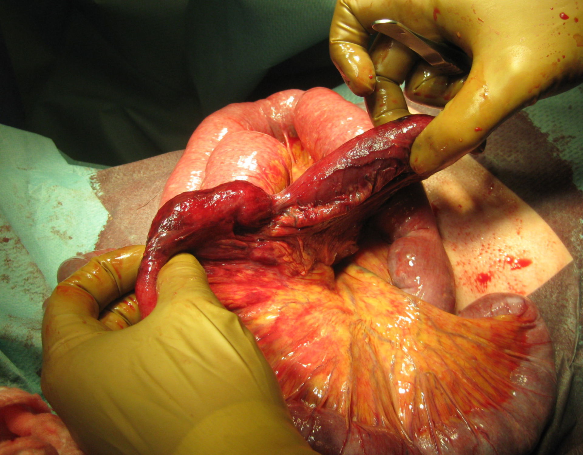 Adhesions of the small intestine leading to ileus and necrosis