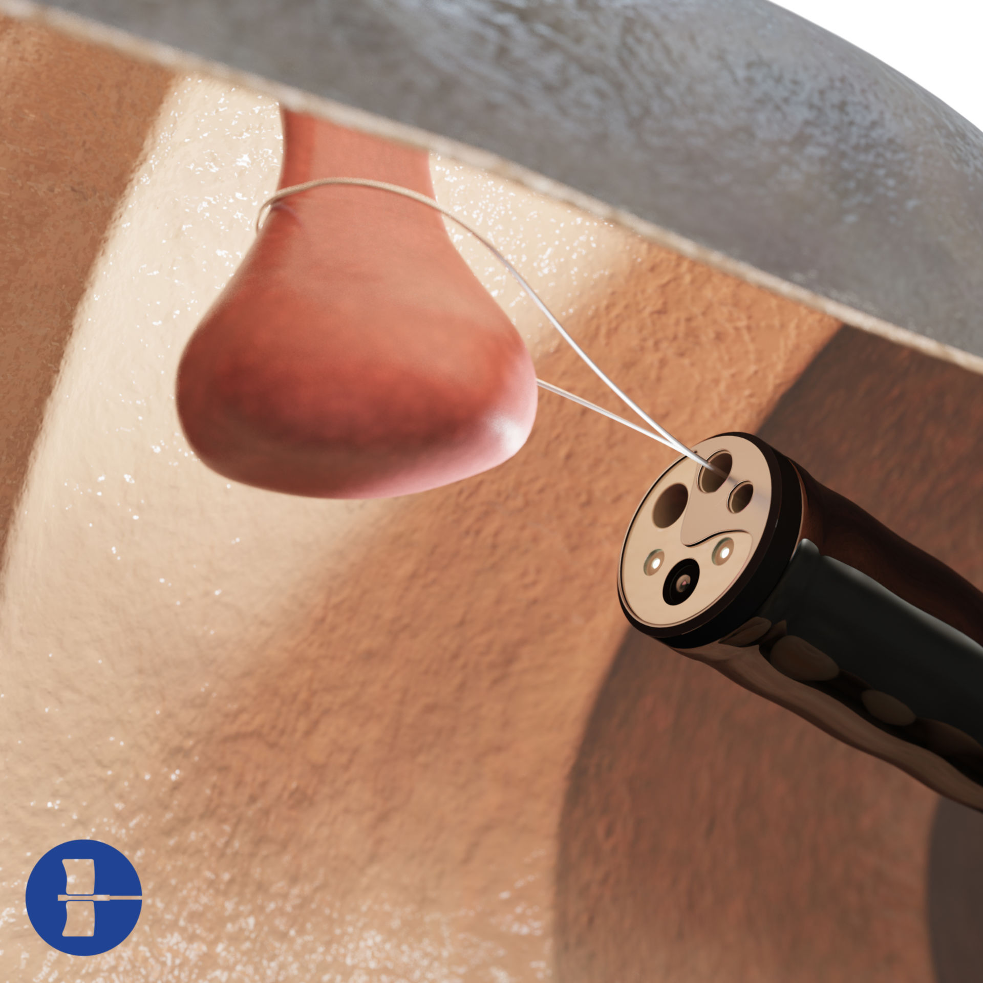 Removing a polyp