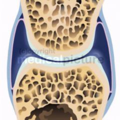 bursita prepatelara cum se tratează artroza articulațiilor cotului