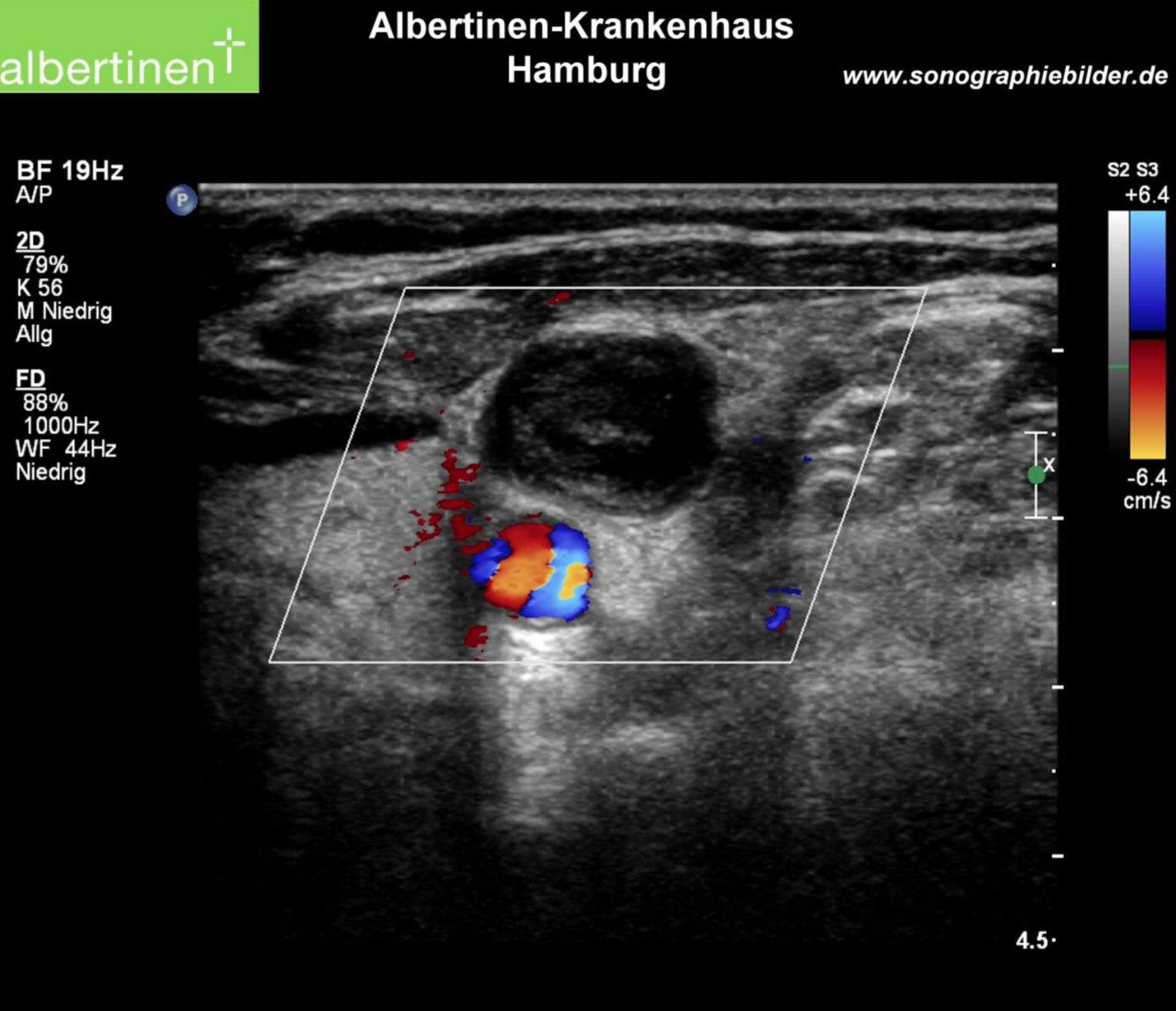 Axillaristhrombose quer