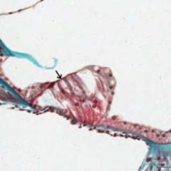 Membrana Interossea Verletzung Clipart