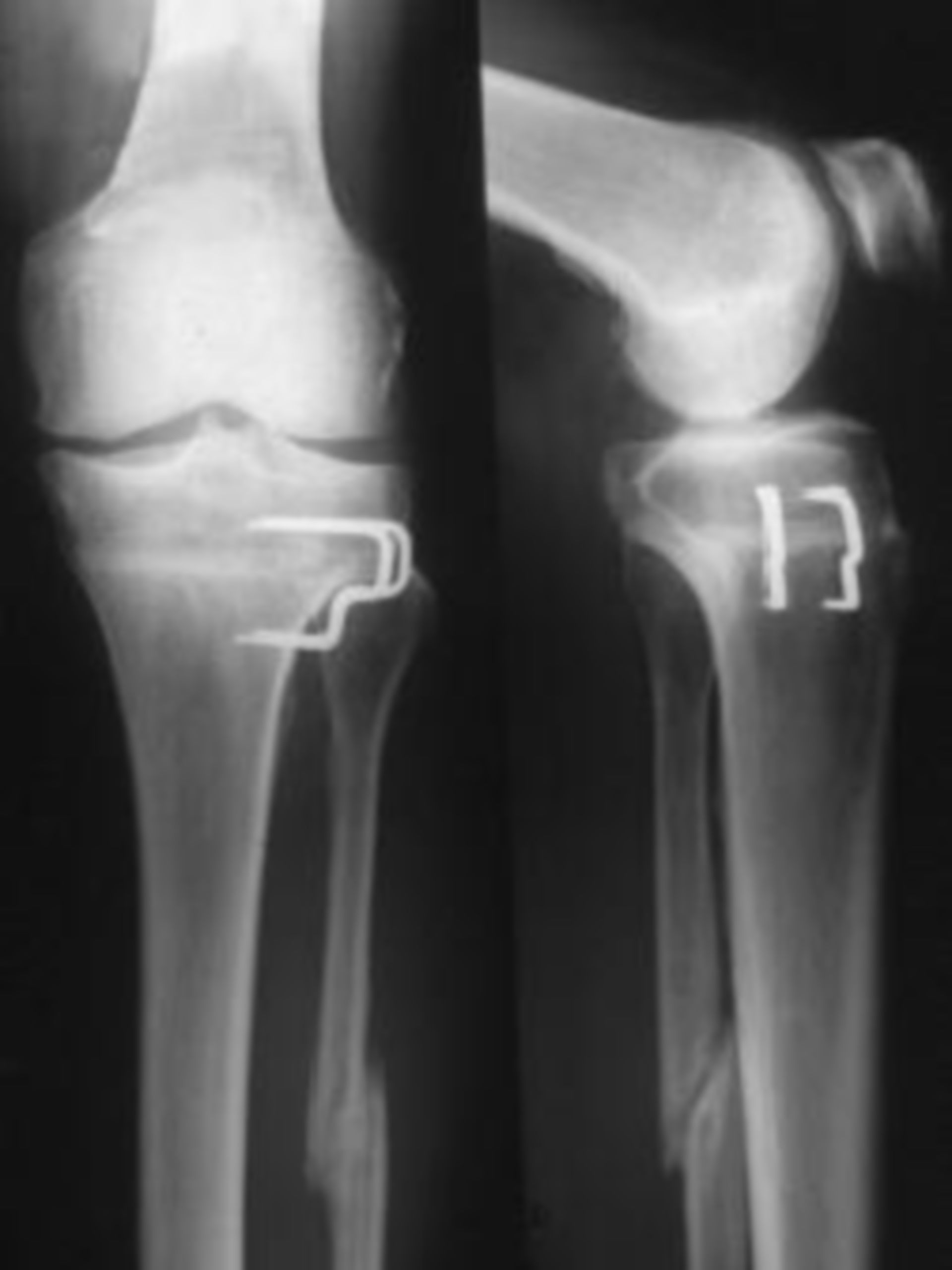 Correction of the knee joint axis at O-leg (genus varum)