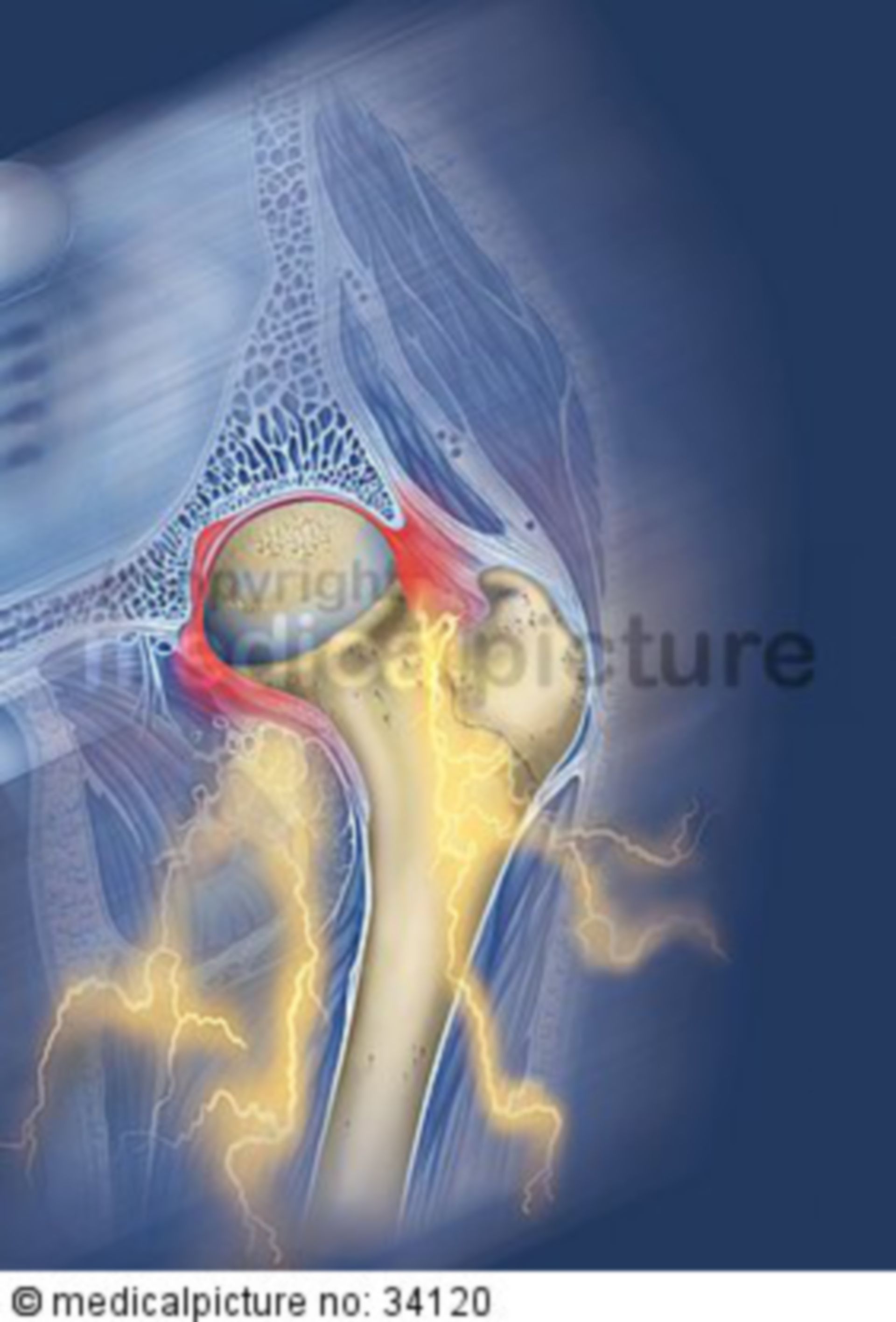 Arthrosis of the hip joint (coxarthrosis)